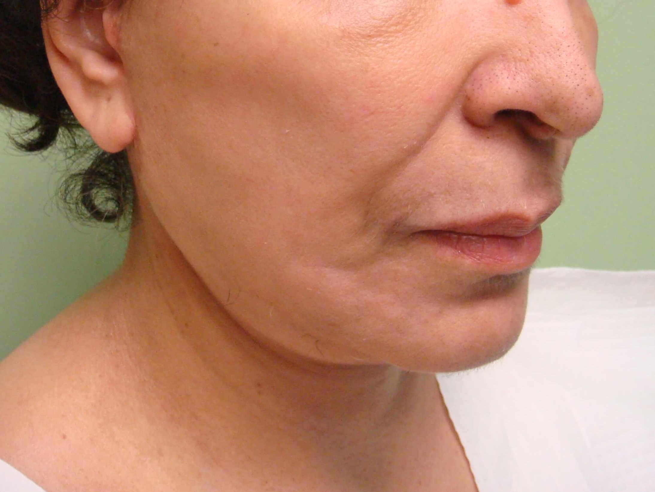 Facelift with Necklift After