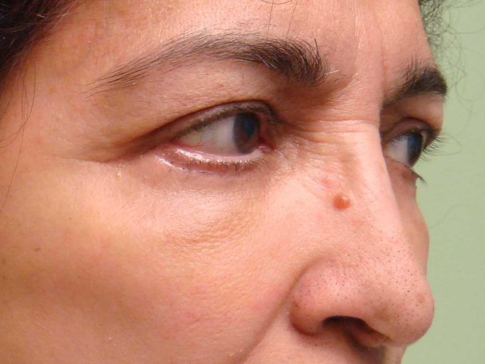 Upper/Lower Blepharoplasty After