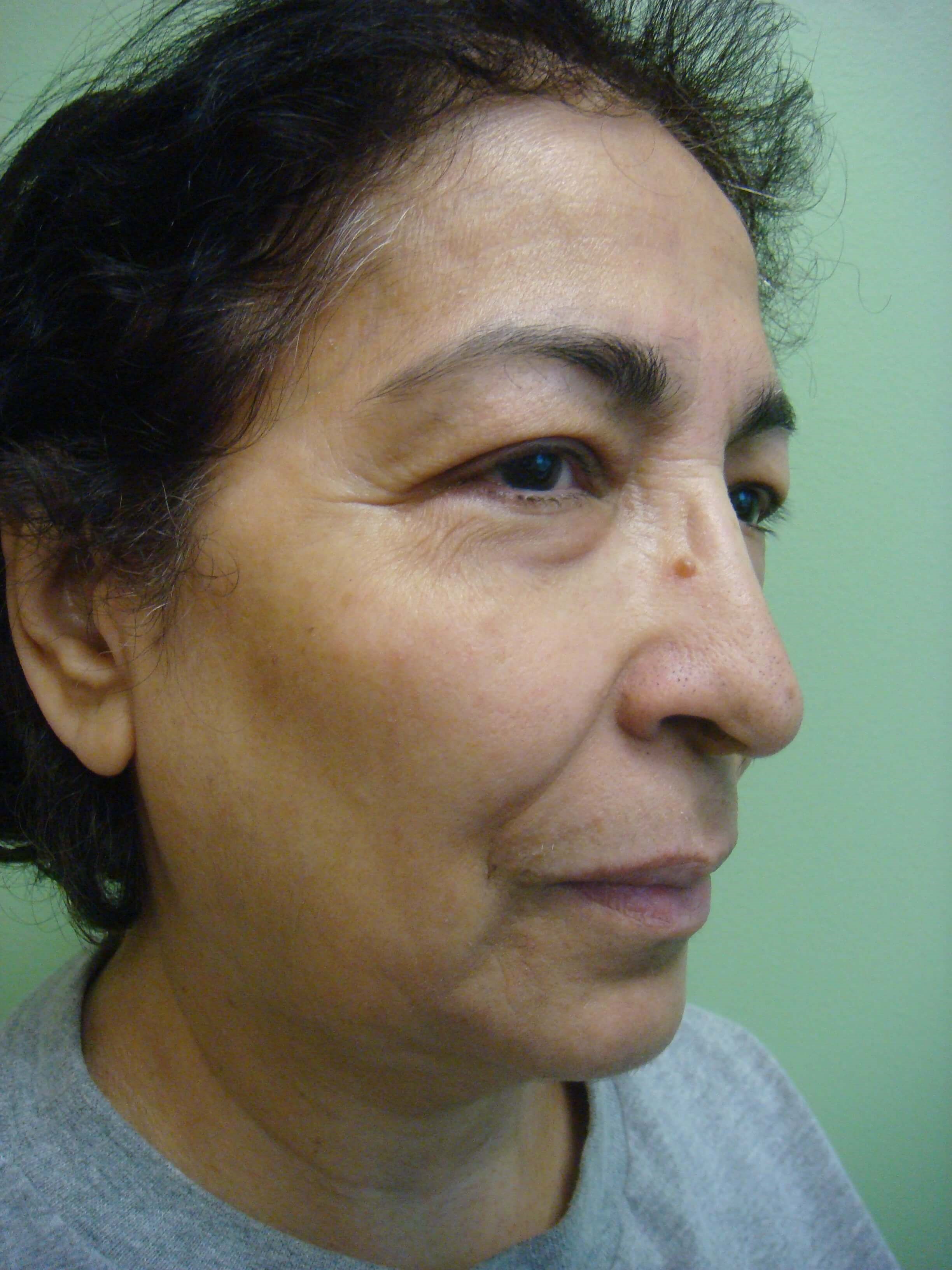 Upper/Lower Blepharoplasty Before
