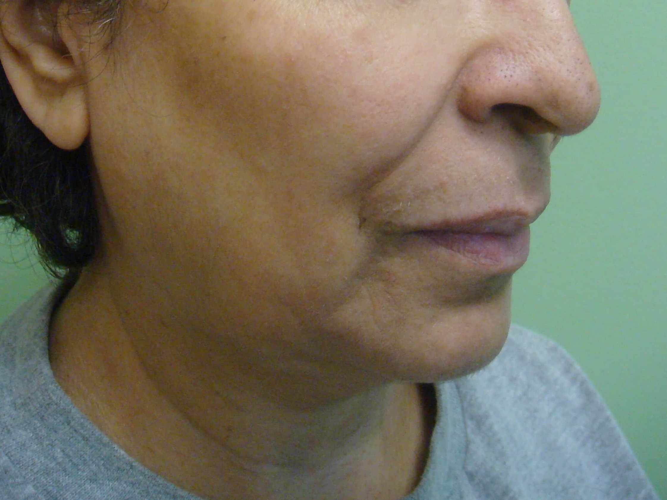 Facelift with Necklift Before
