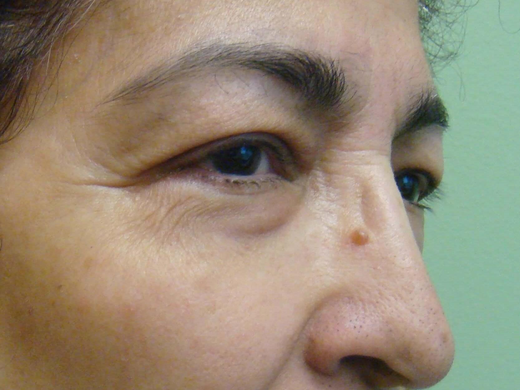 Upper/Lower Blepharoplasty Before