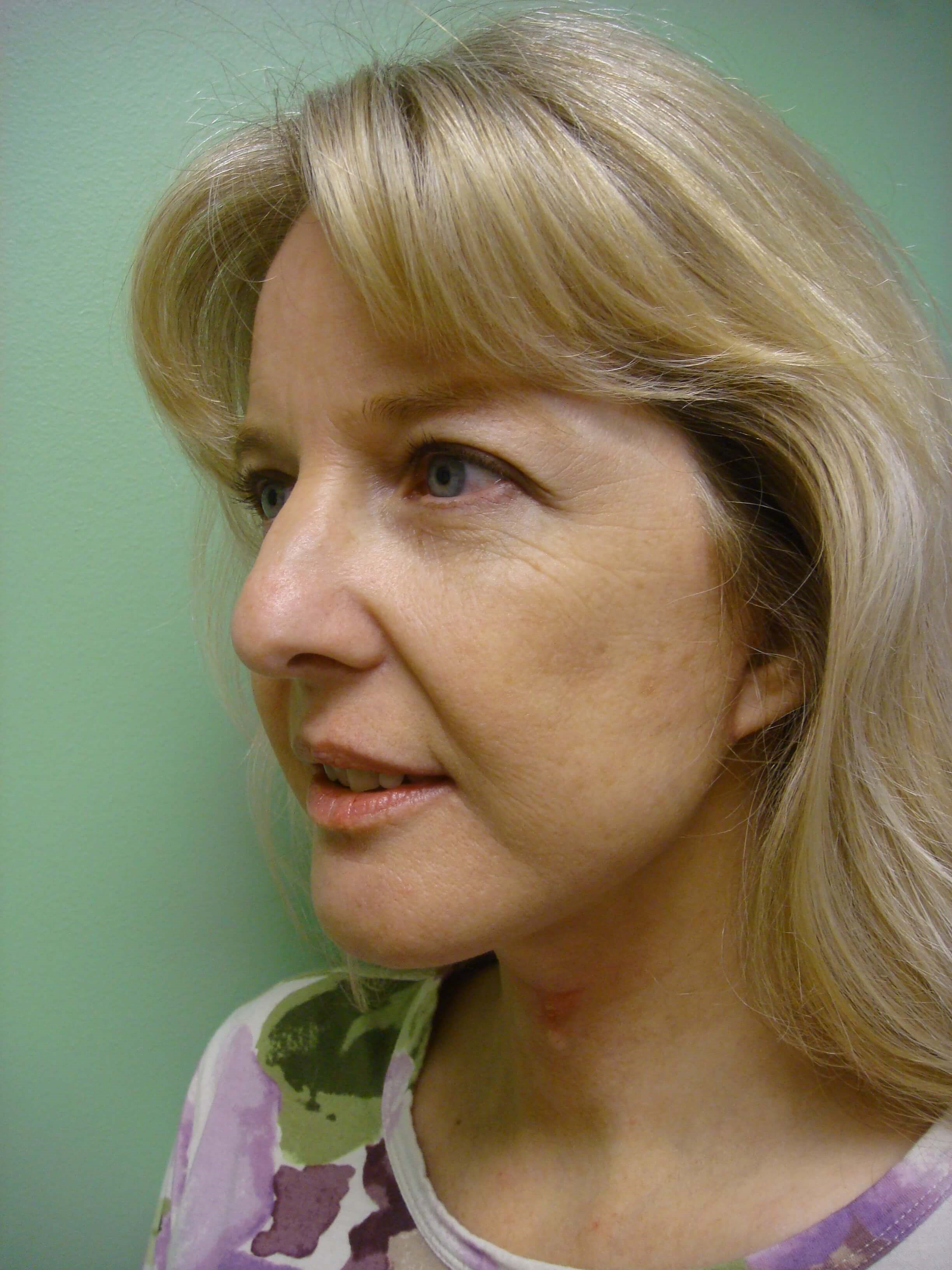 Necklift After