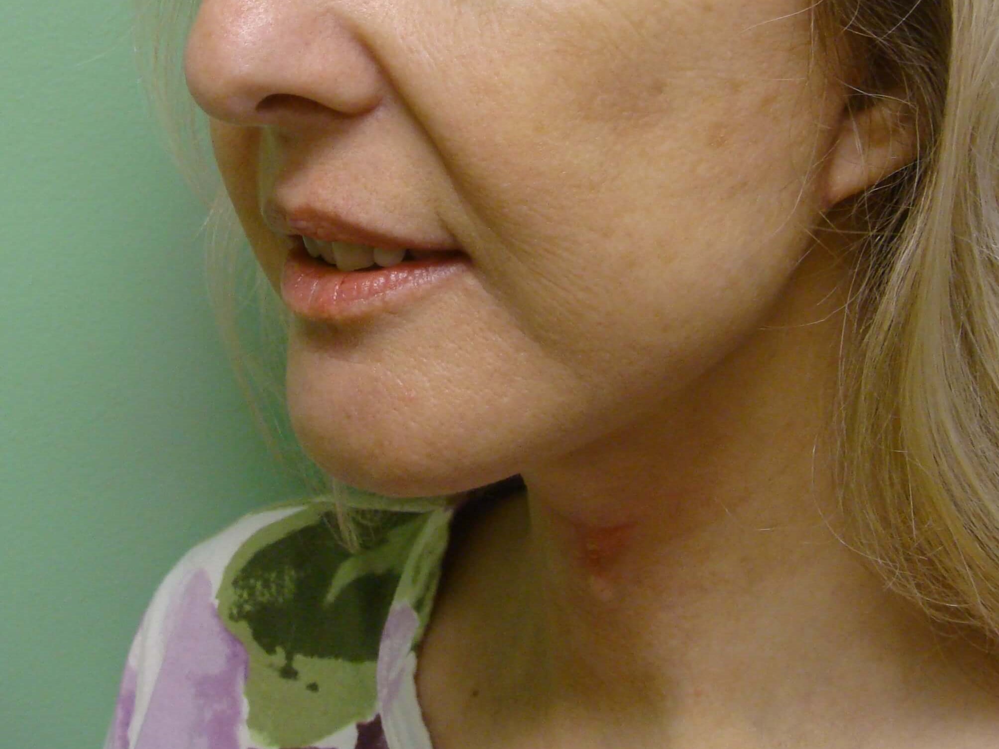 Necklift After
