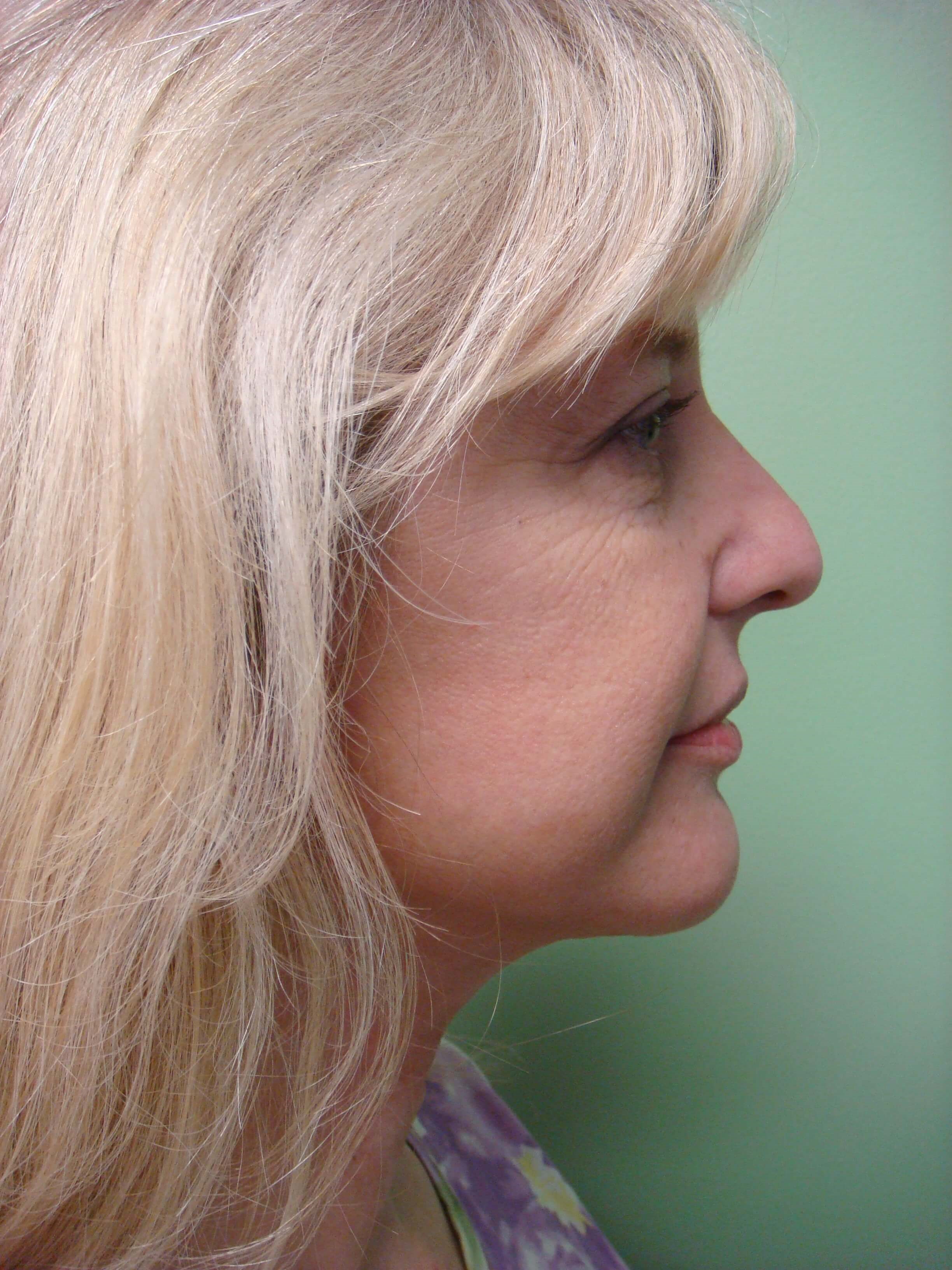 Necklift After