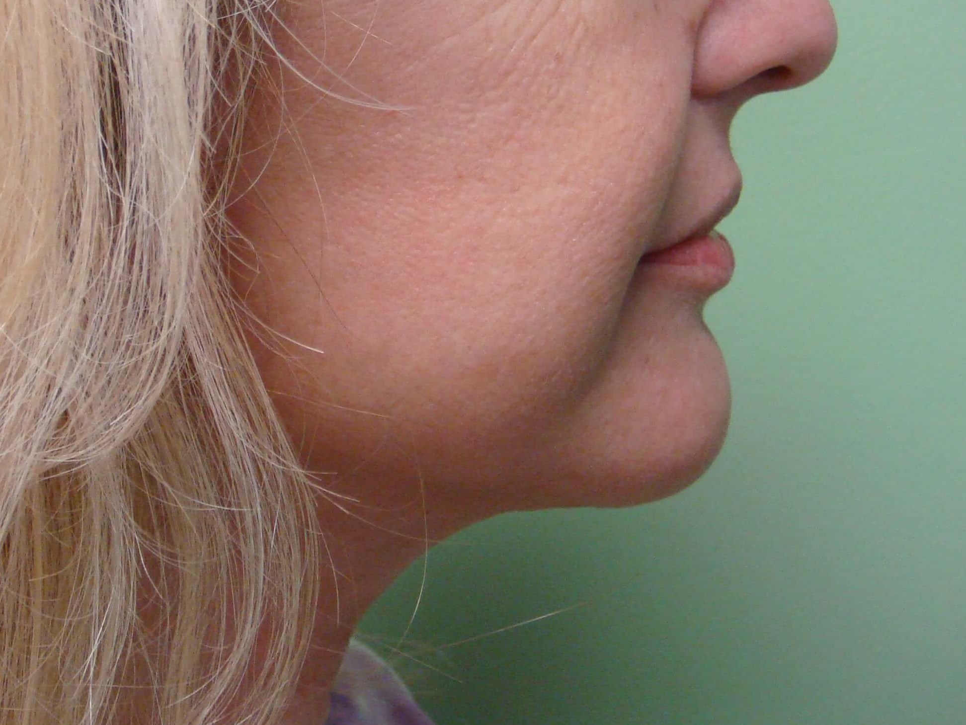 Necklift After