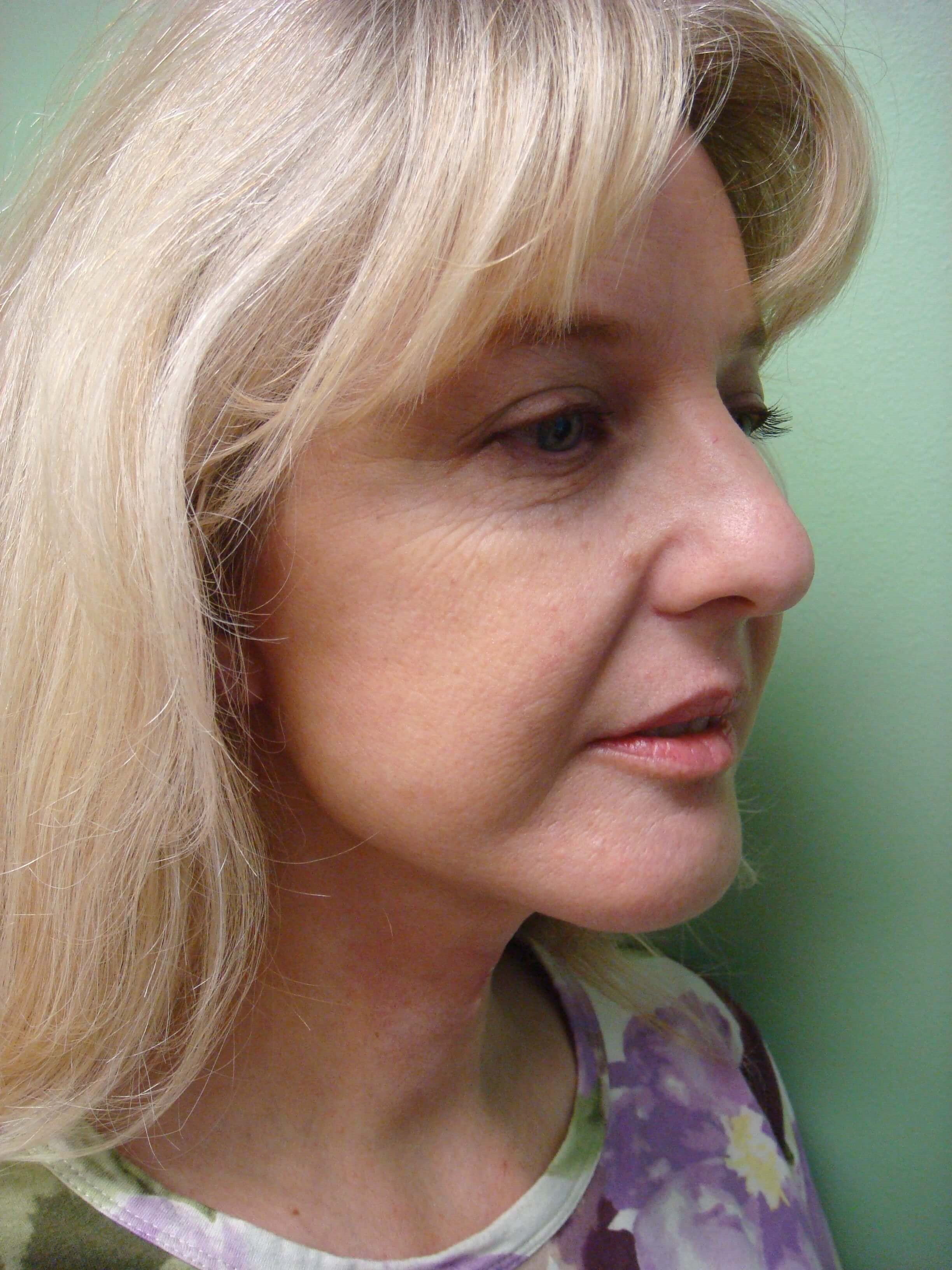 Necklift After