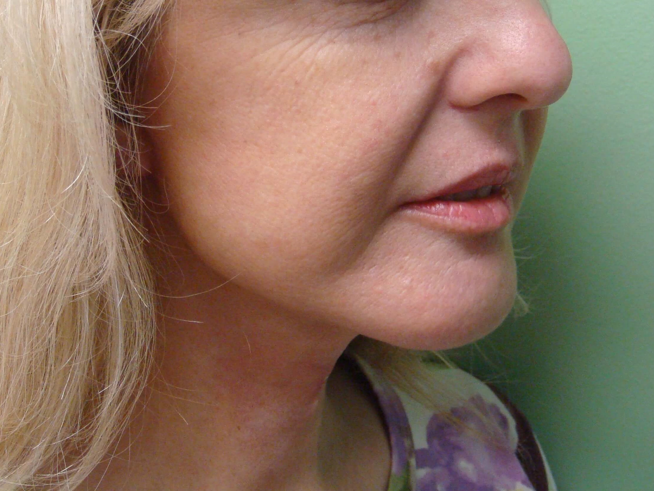 Necklift After