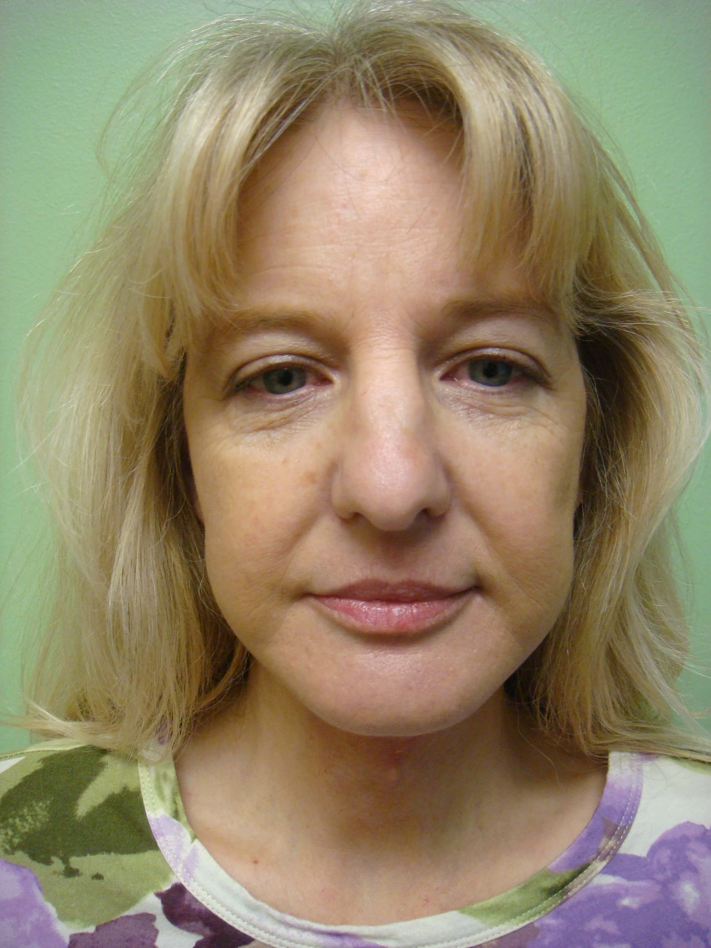 Necklift After