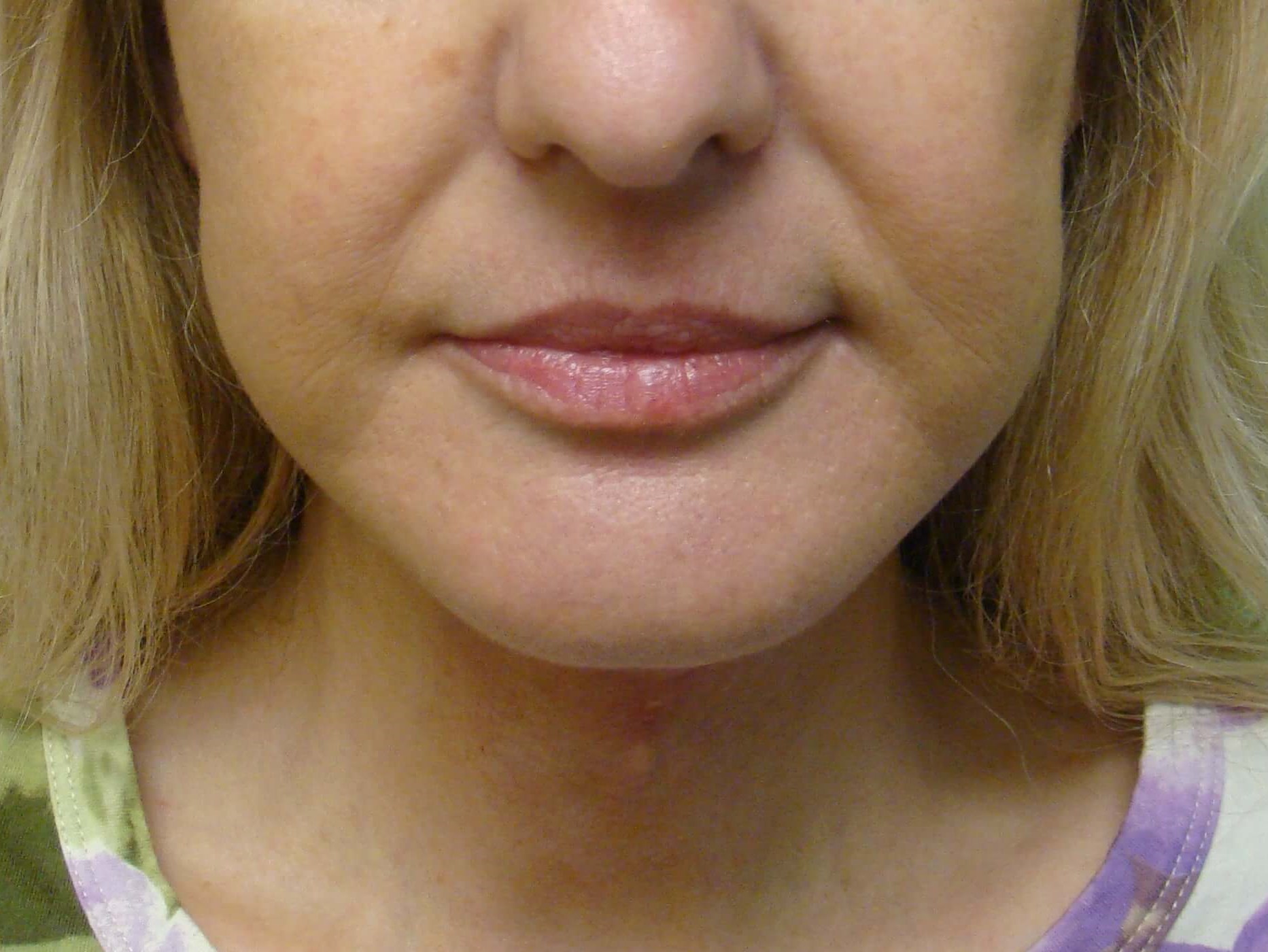 Necklift After