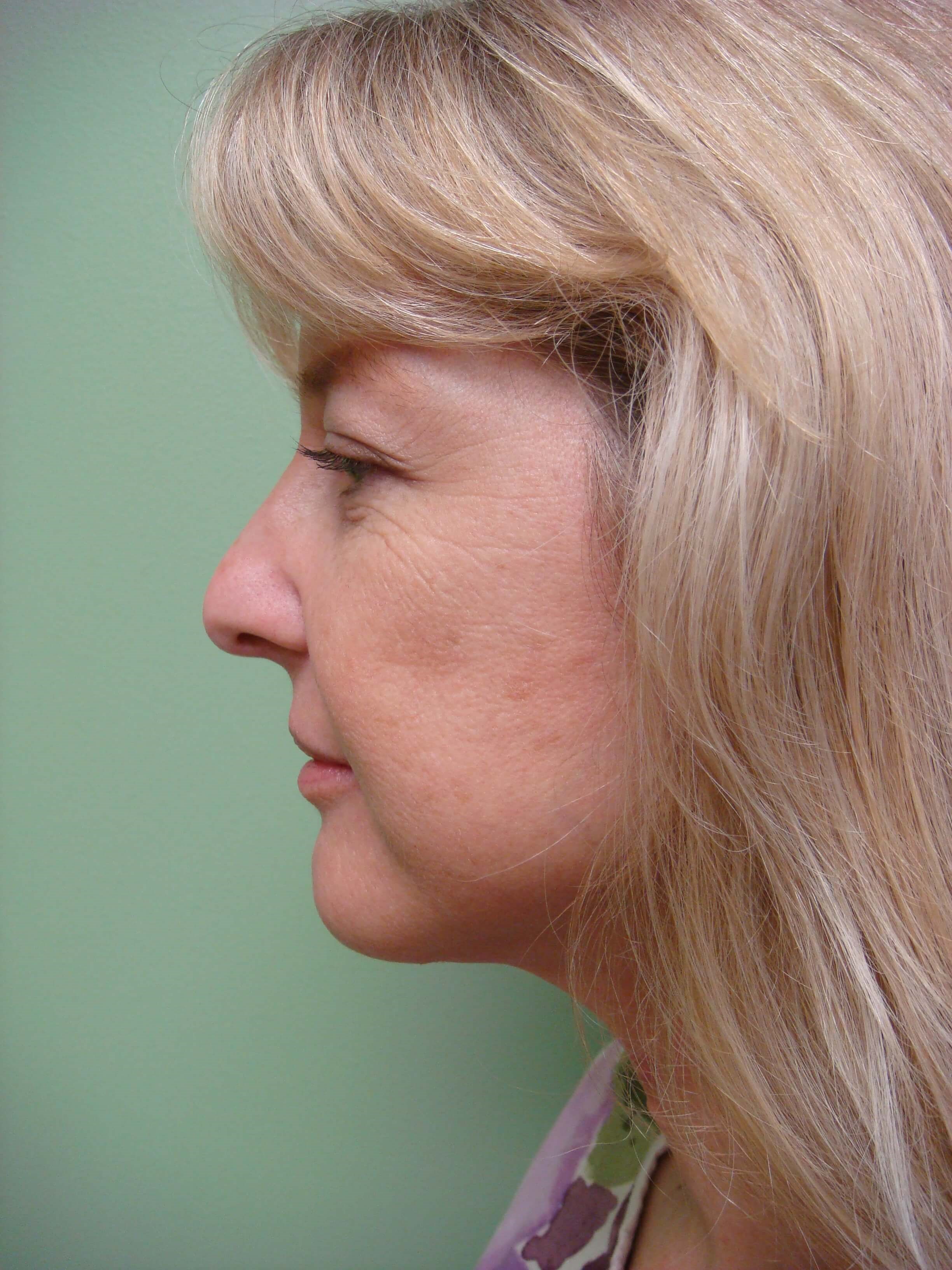 Necklift After