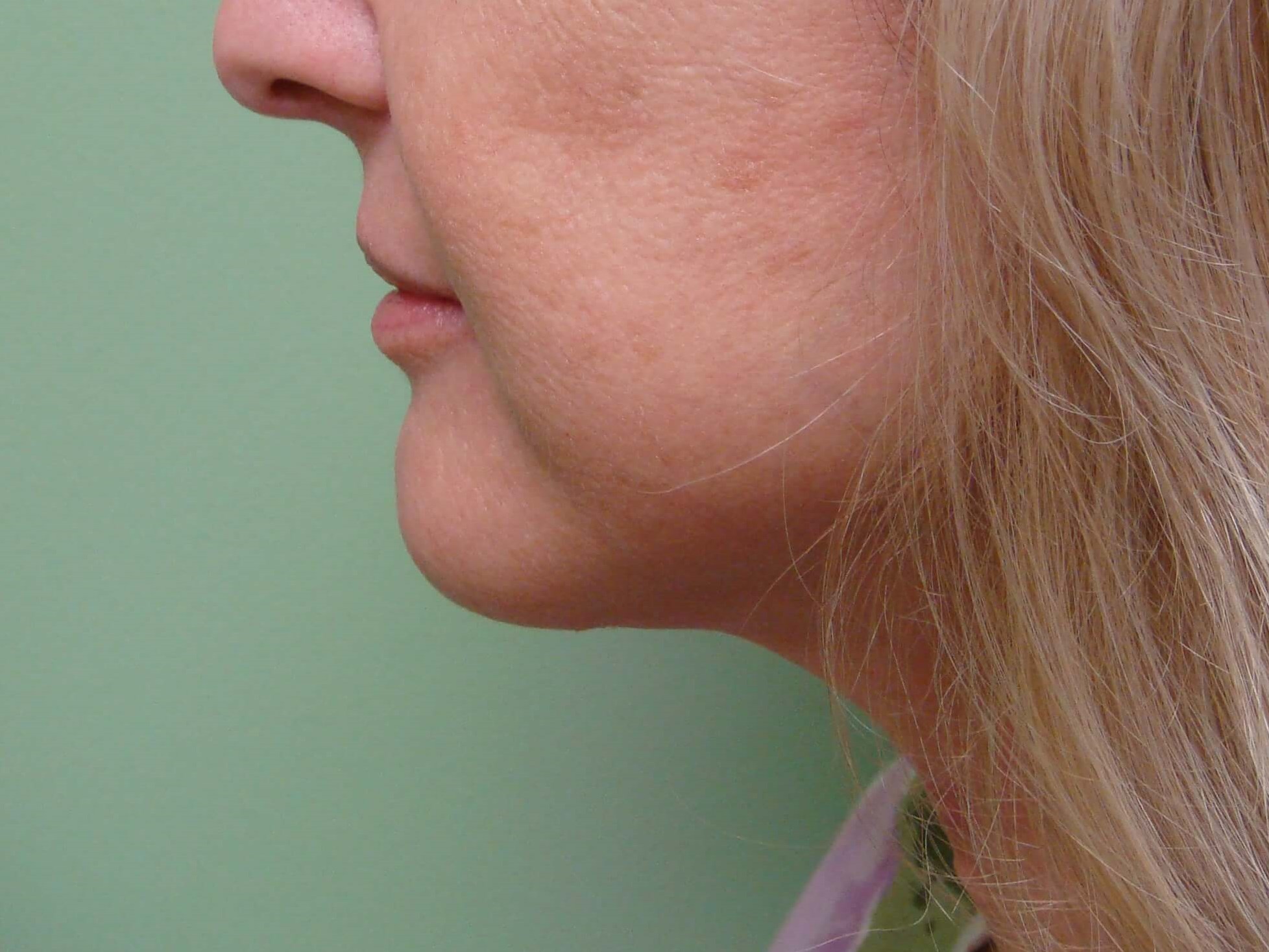 Necklift After