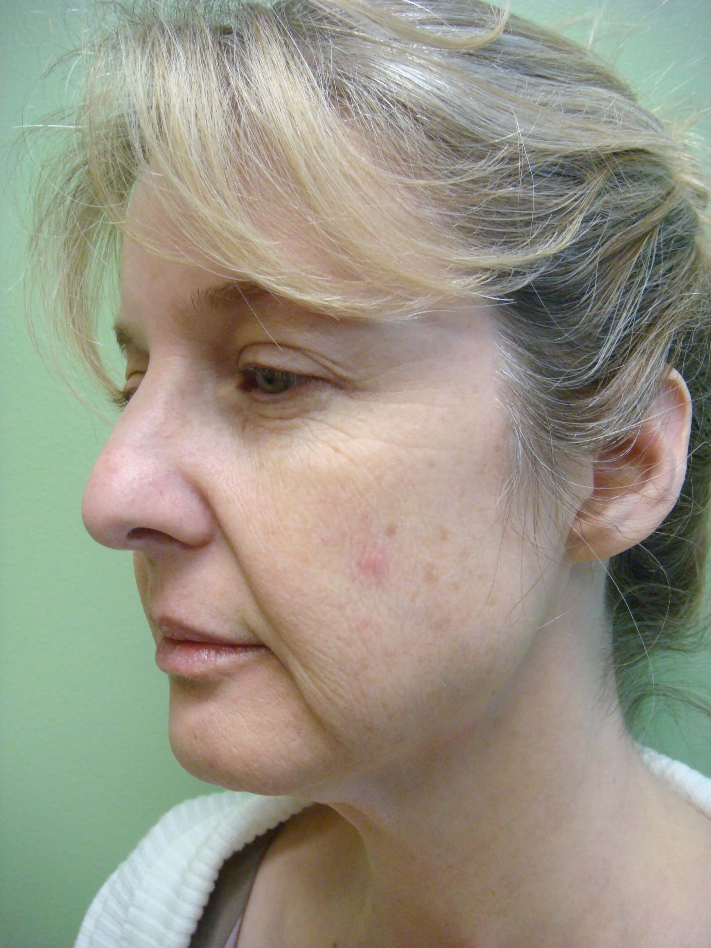 Necklift Before