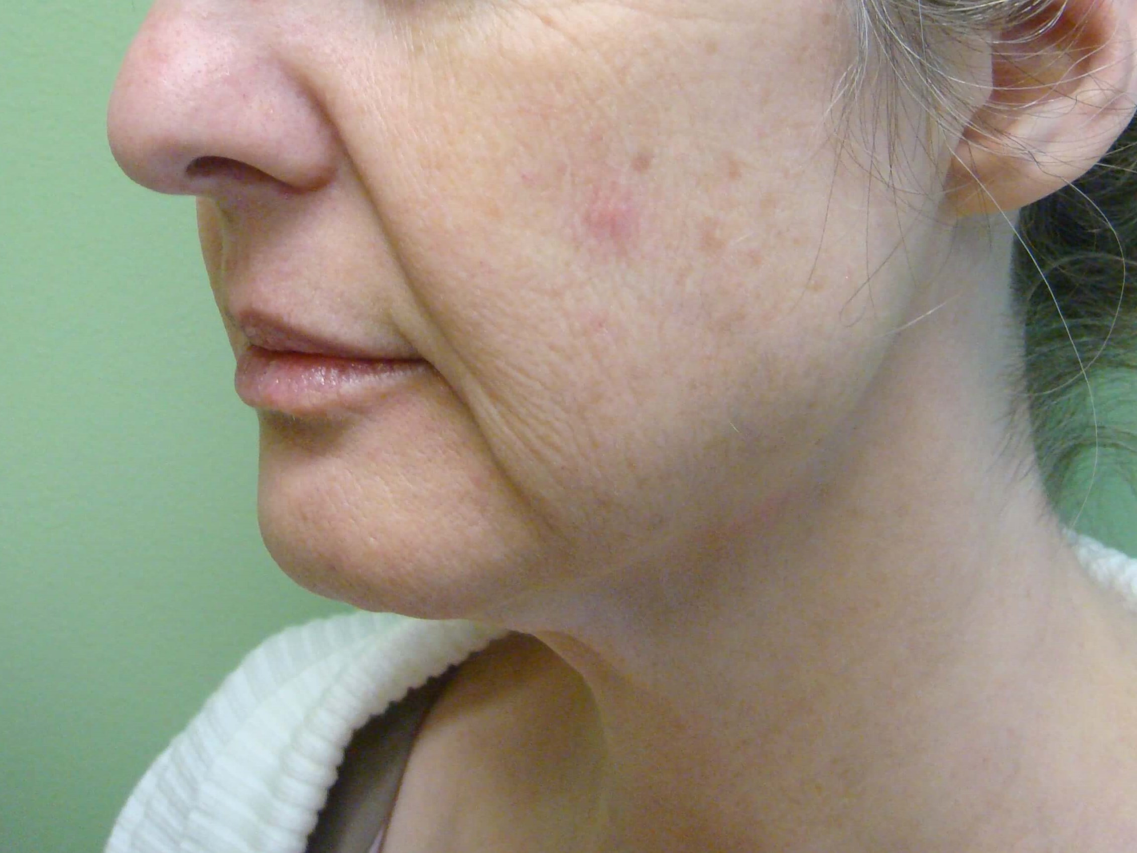 Necklift Before