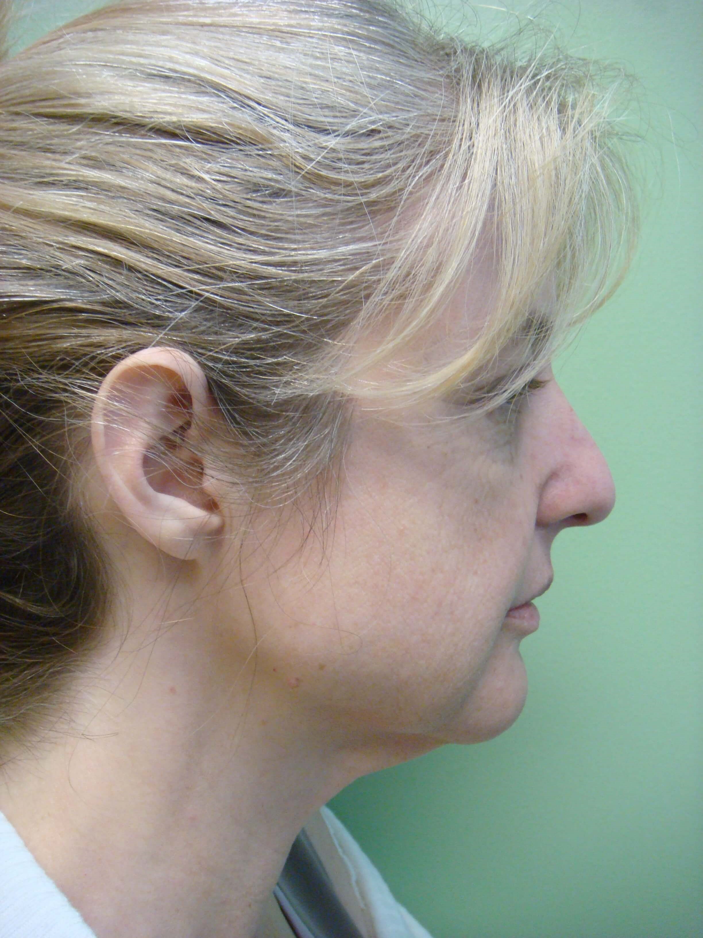 Necklift Before