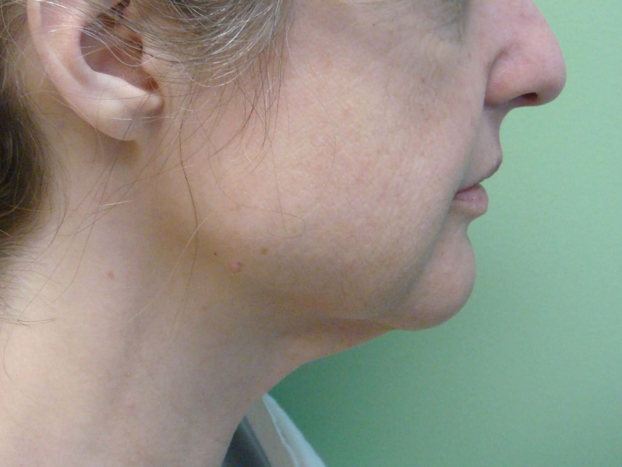 Necklift Before