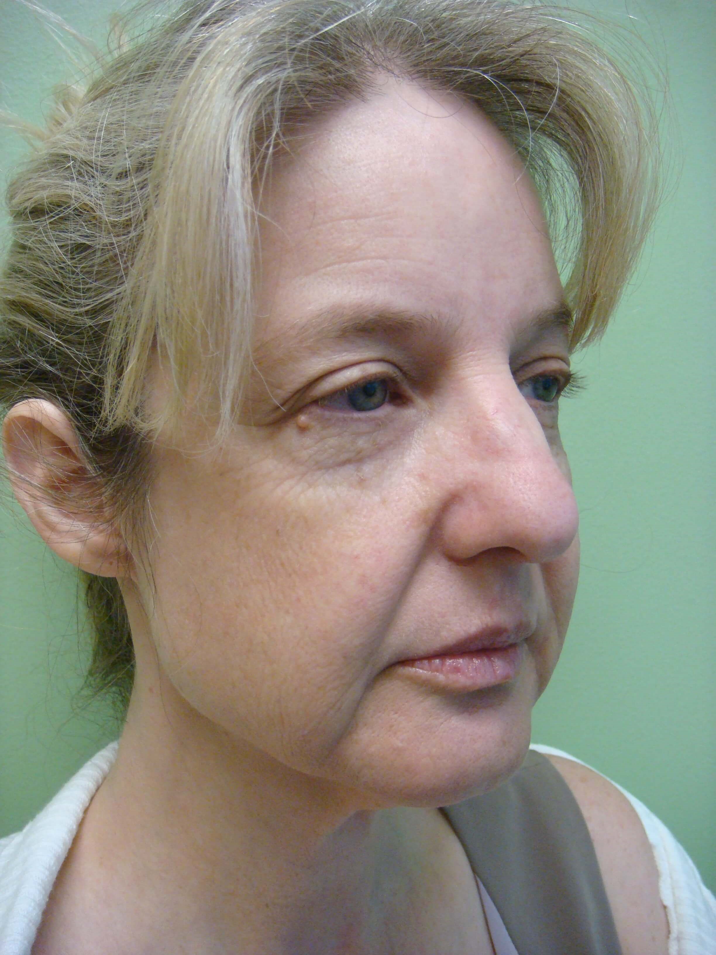 Necklift Before