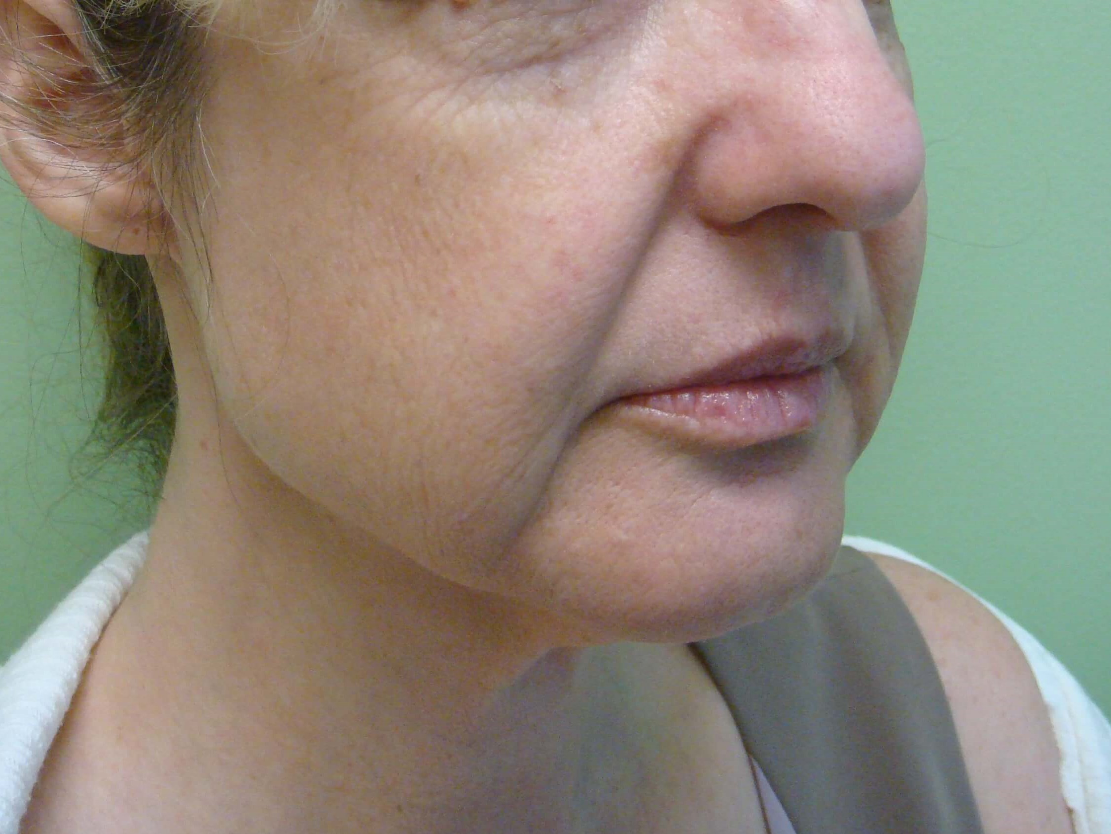 Necklift Before