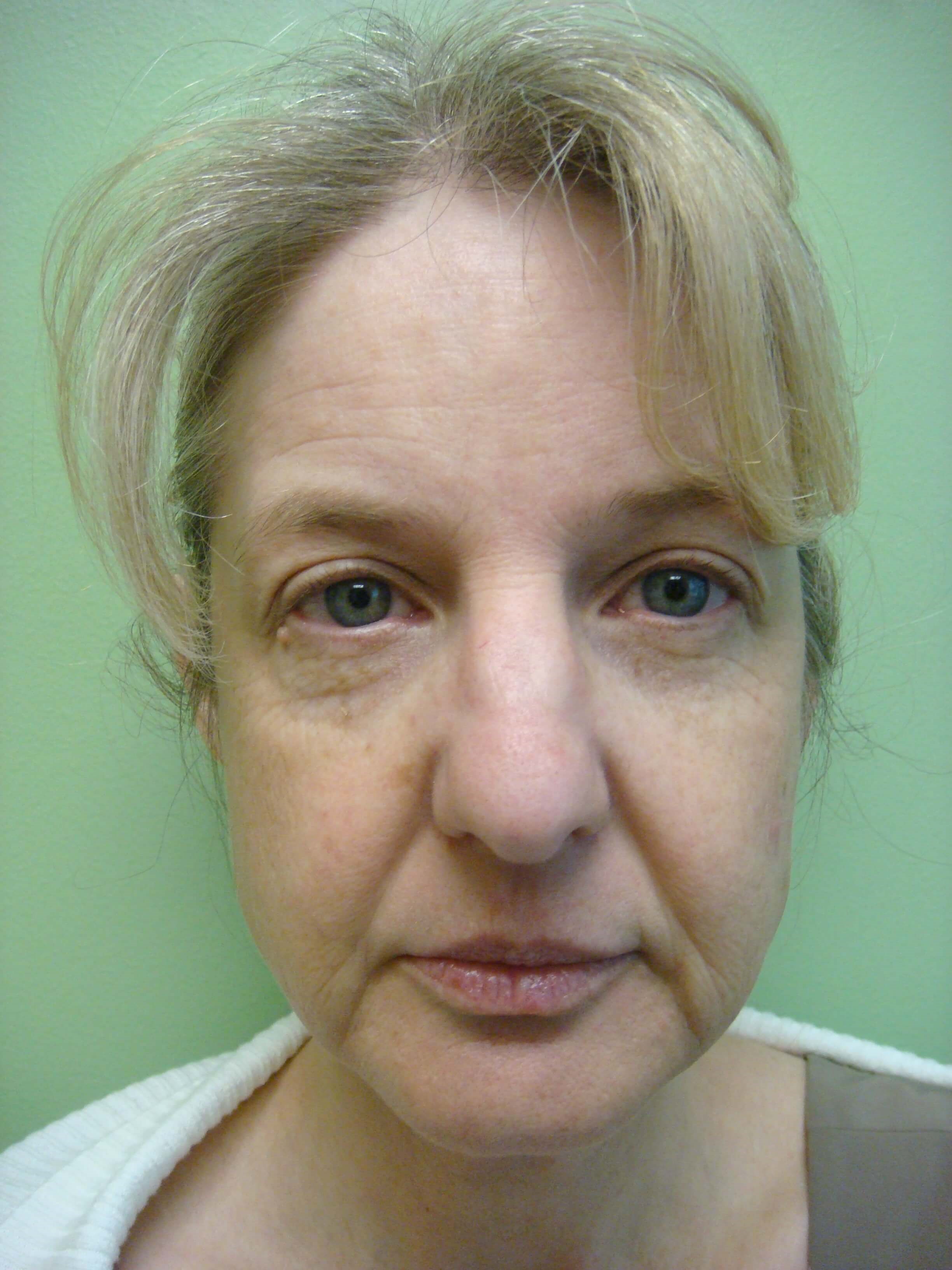 Necklift Before