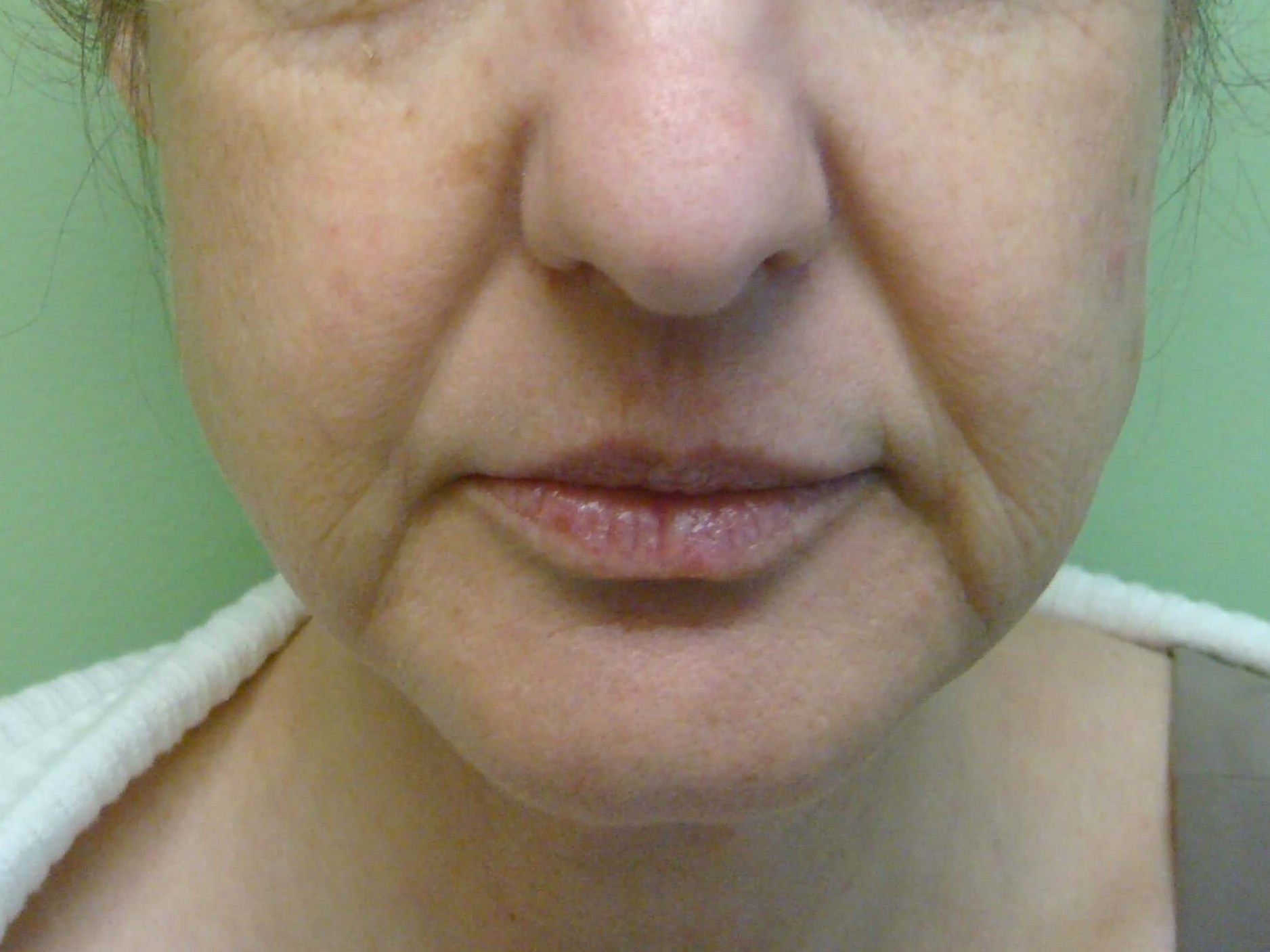 Necklift Before
