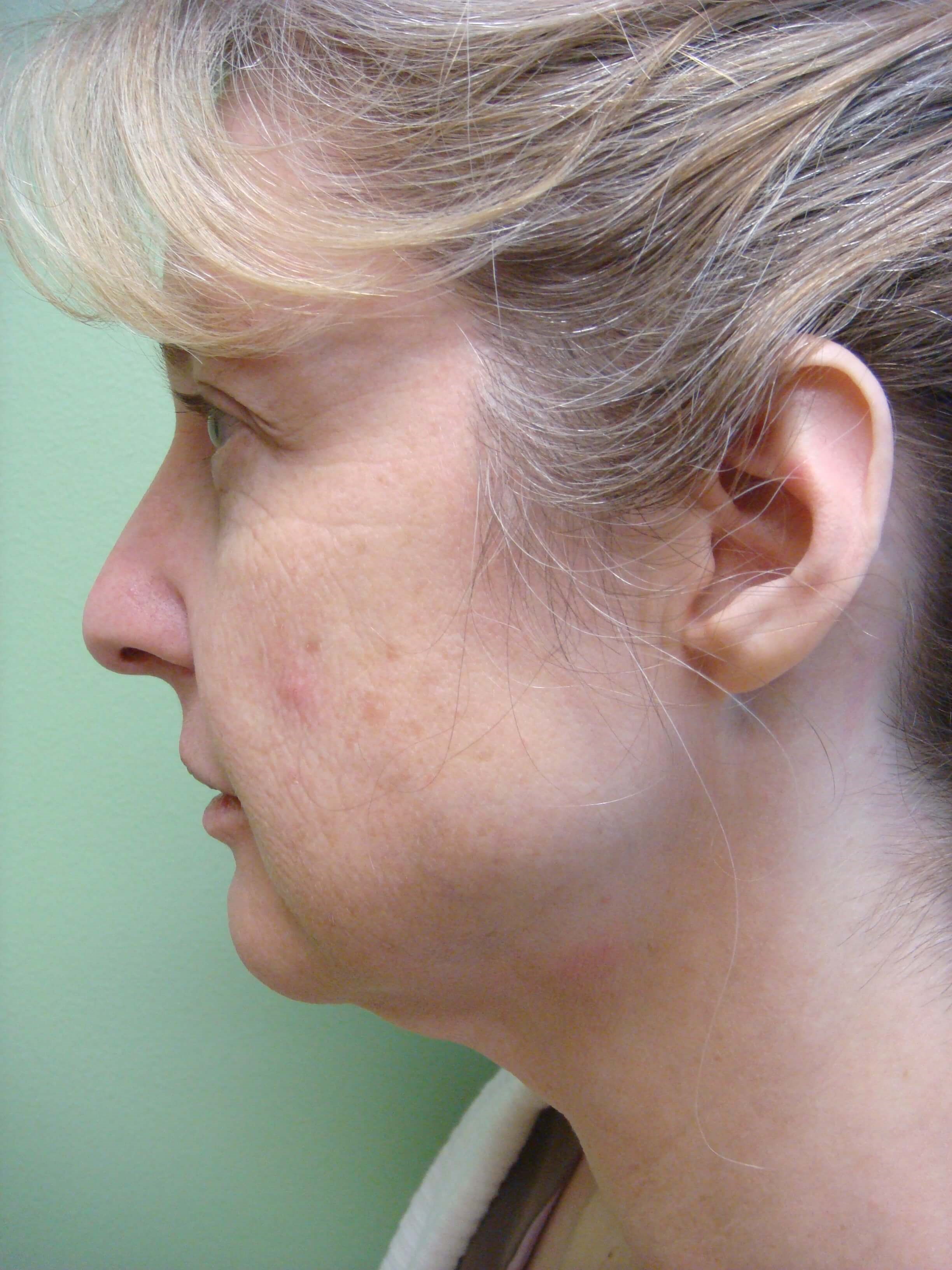 Necklift Before