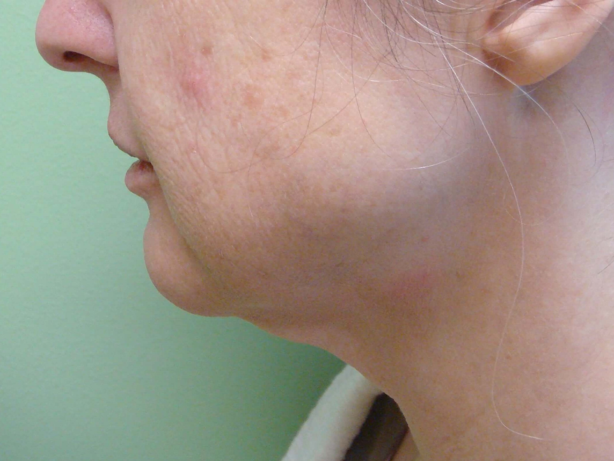 Necklift Before