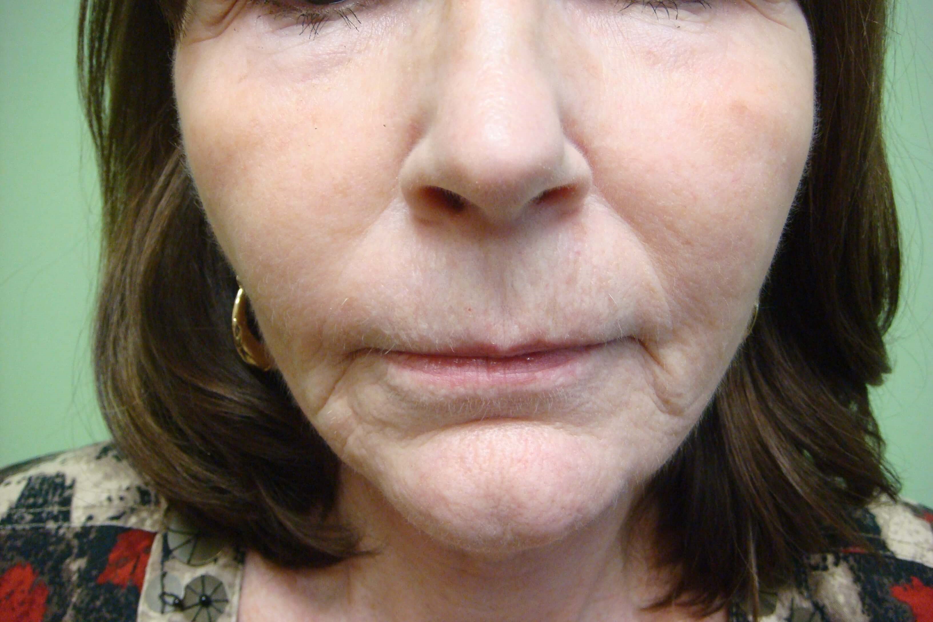 Necklift After