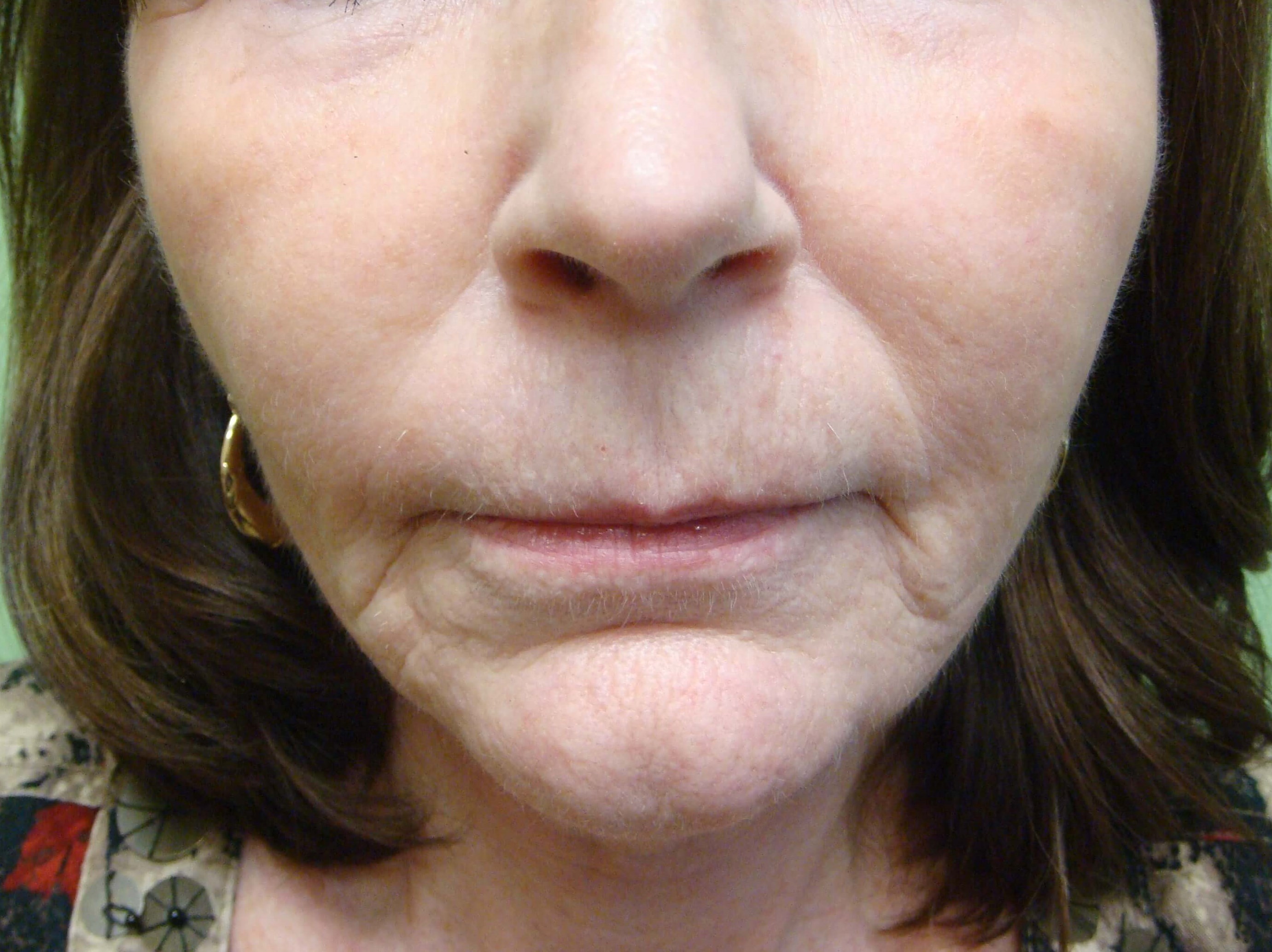 Necklift After