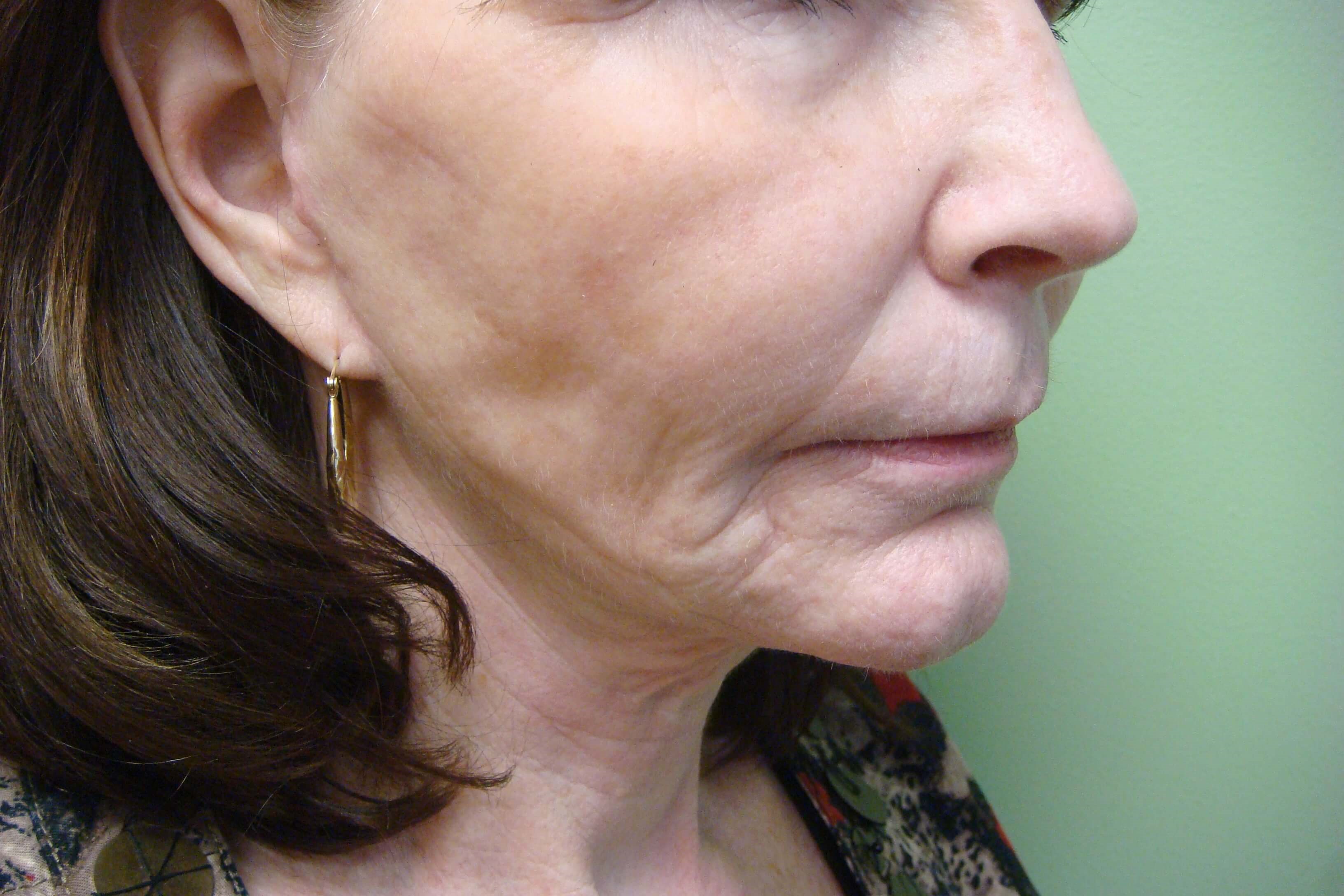 Necklift After