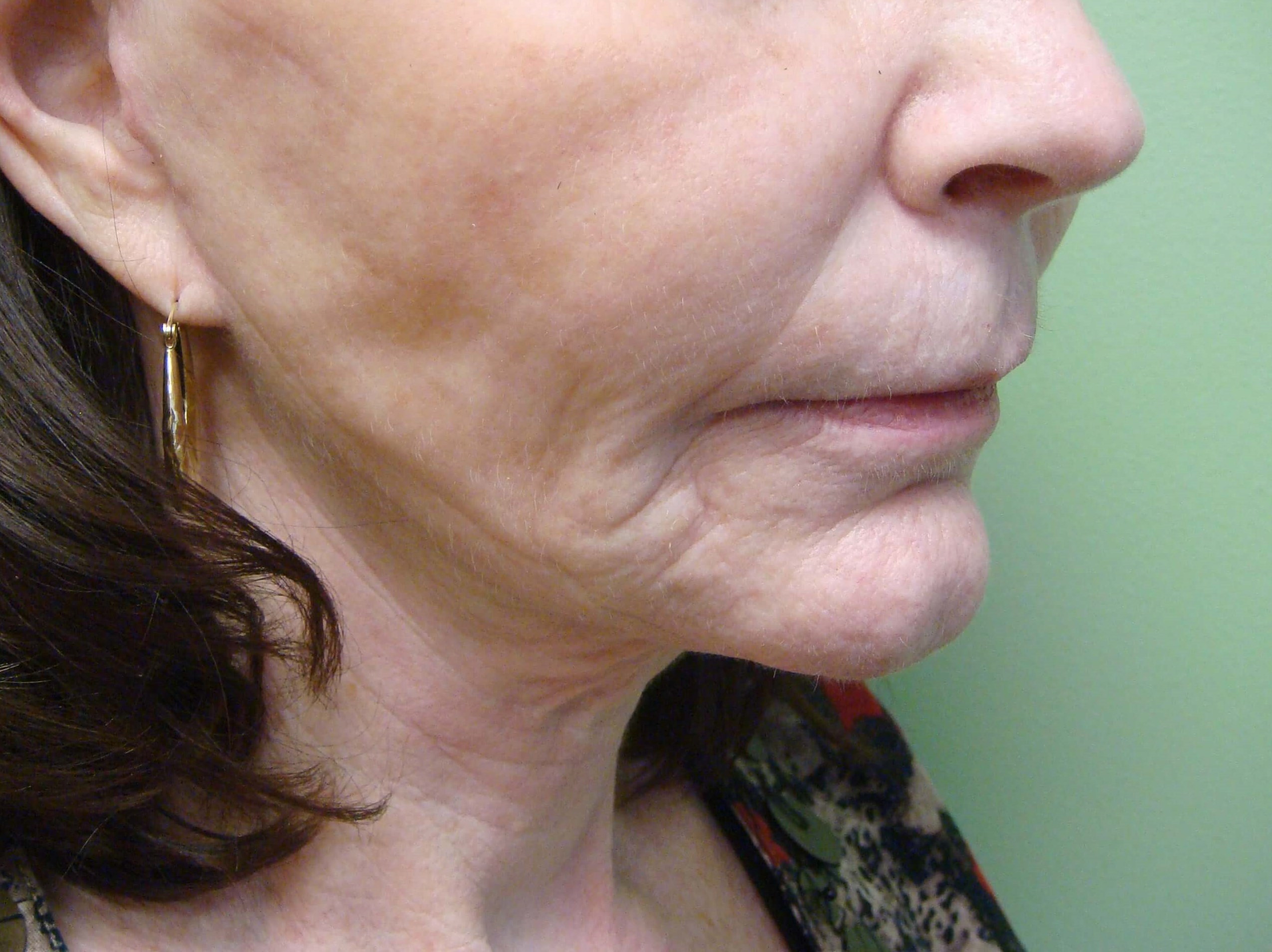 Necklift After