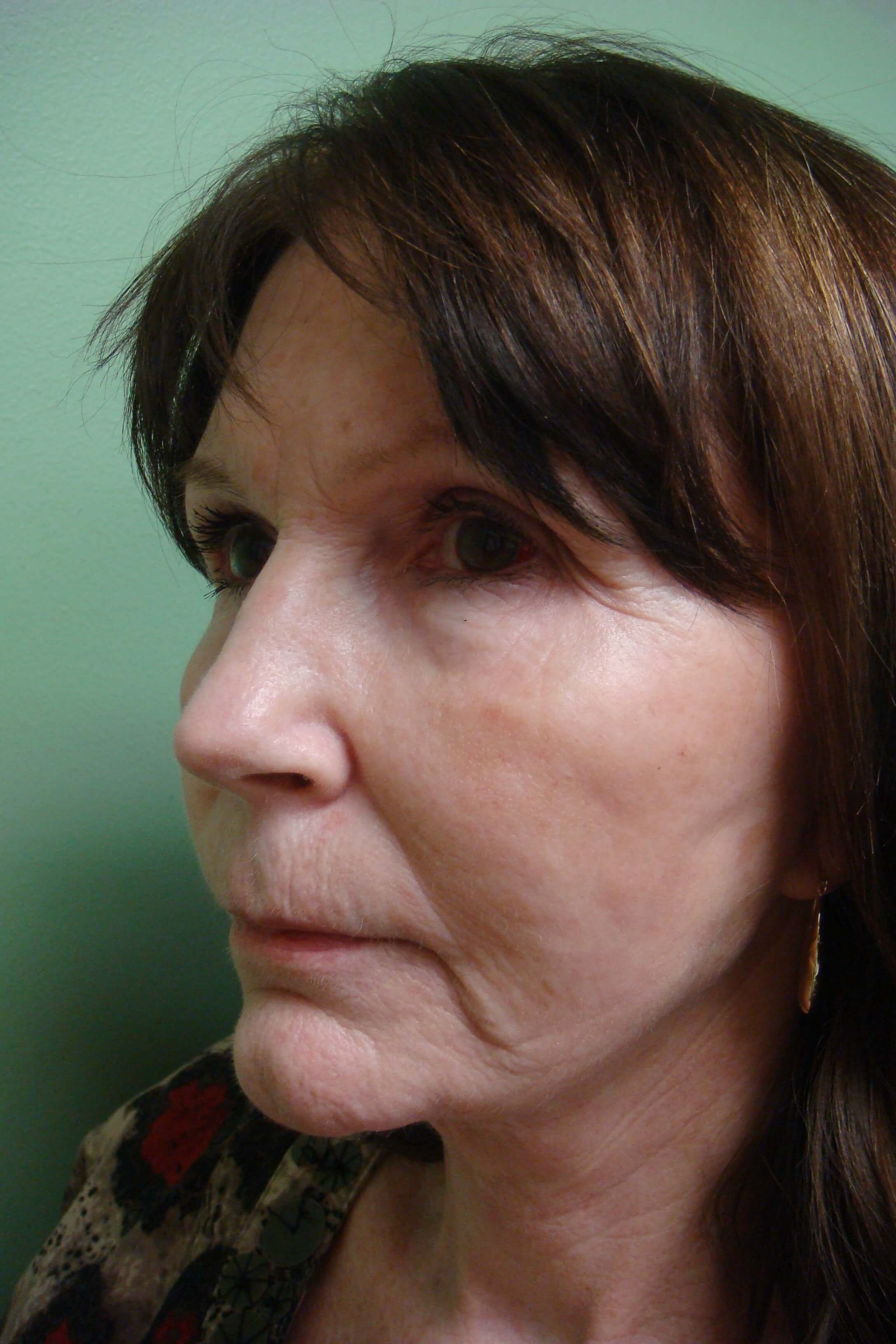 Necklift After