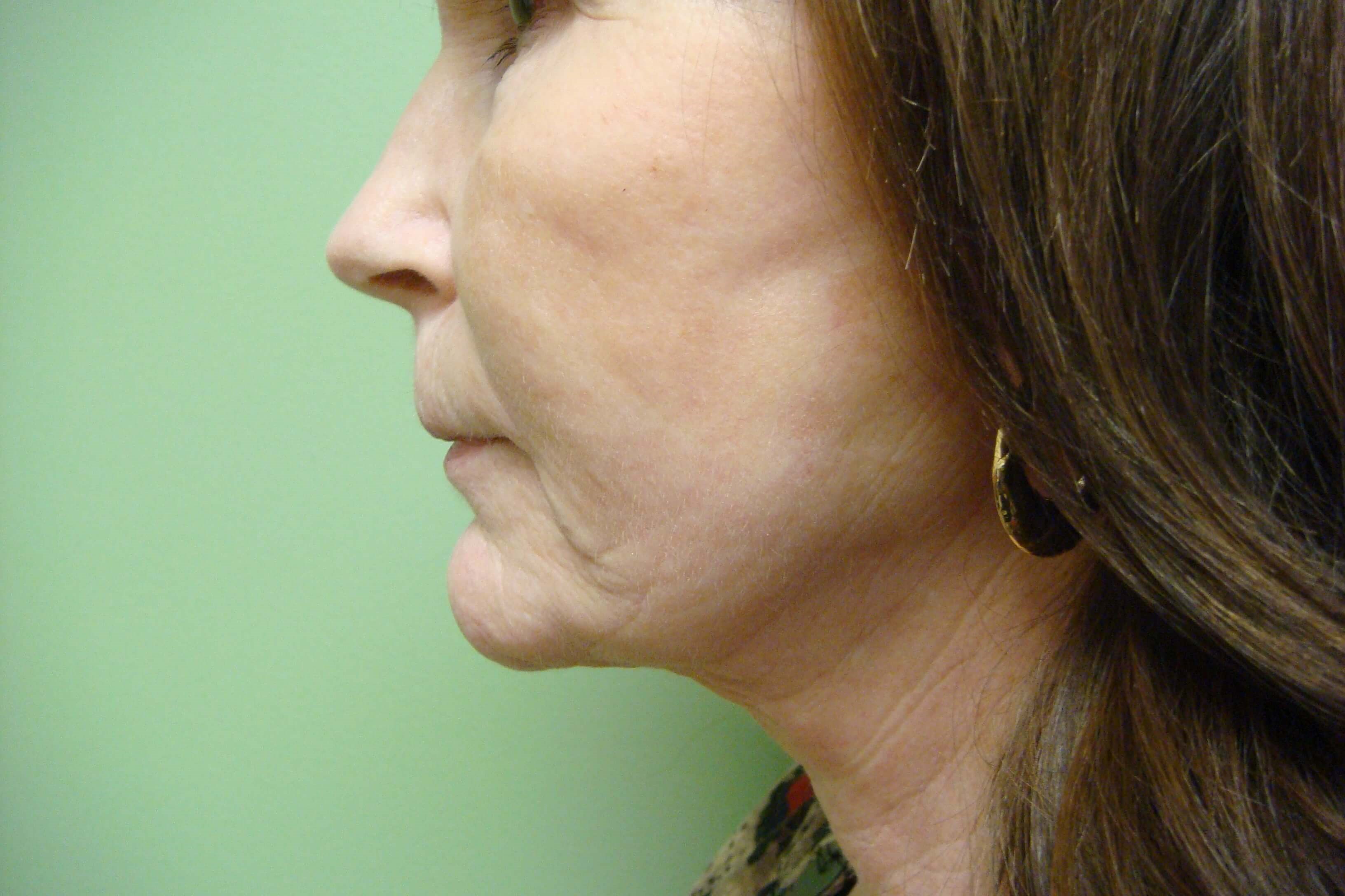 Necklift After