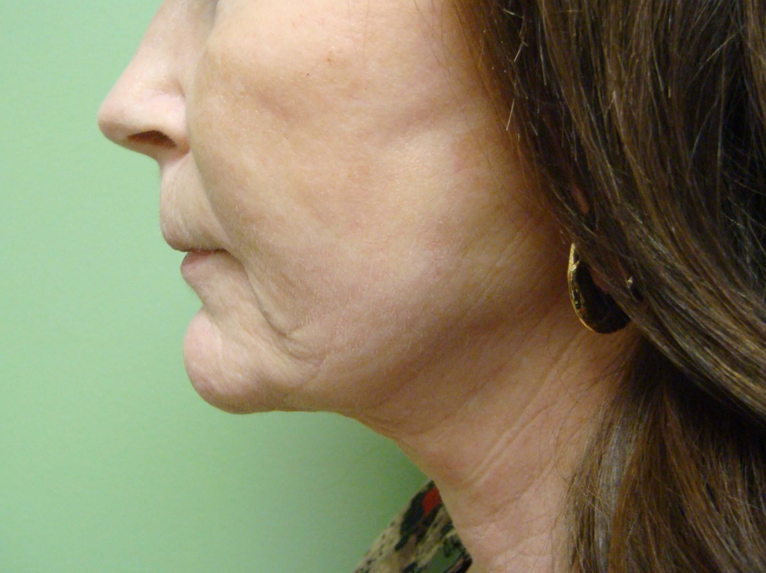 Necklift After