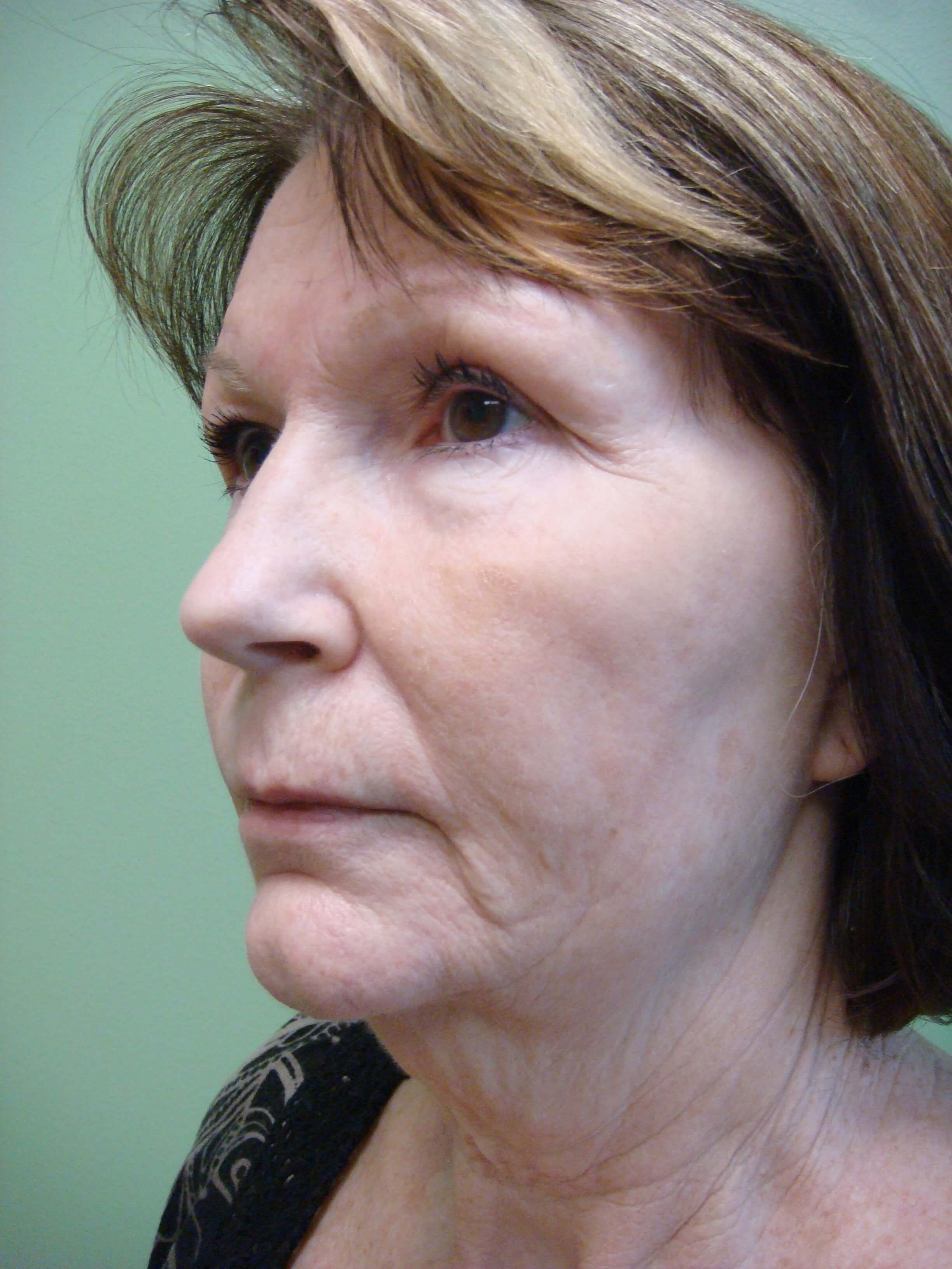 Necklift Before