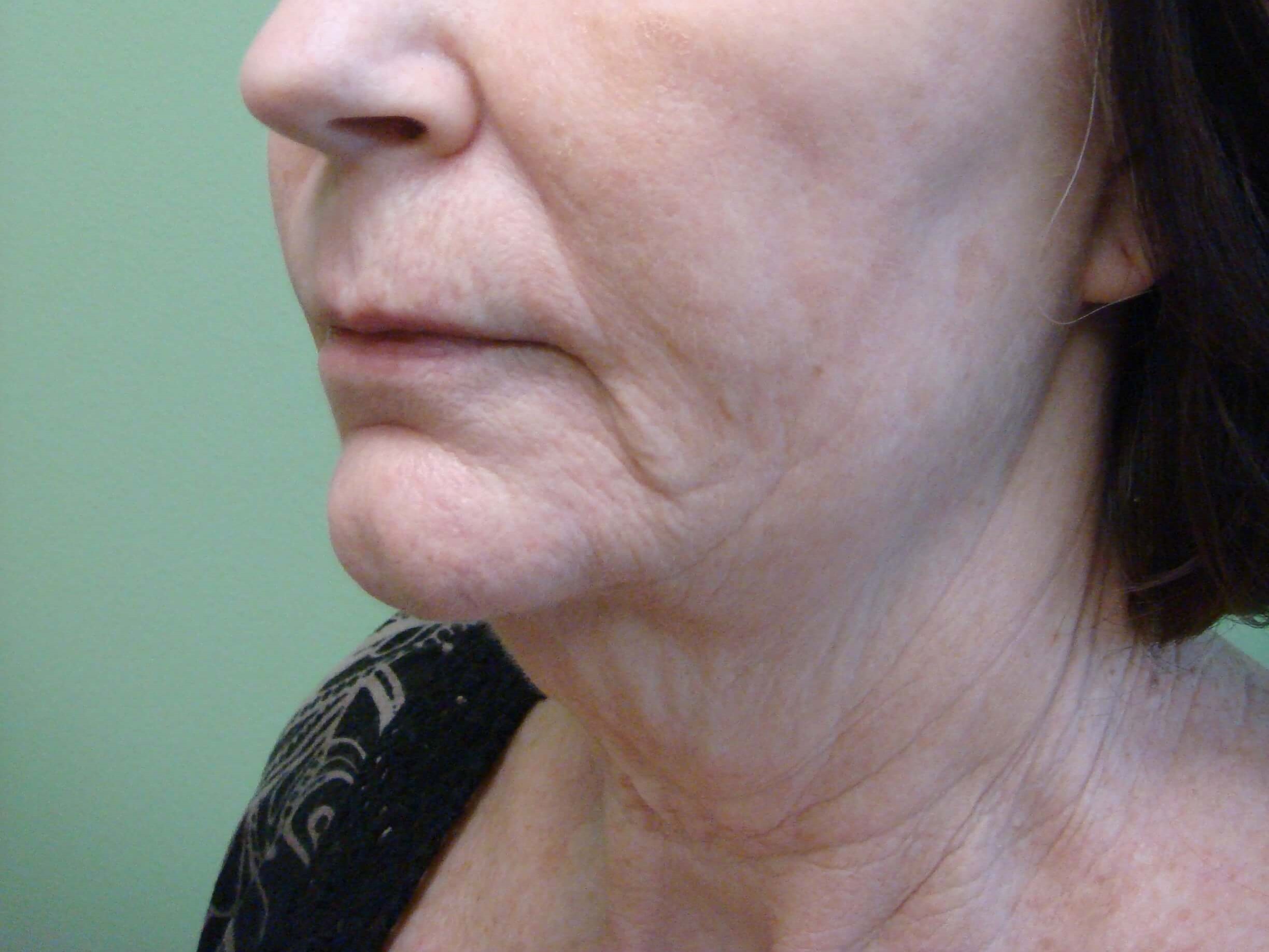 Necklift Before