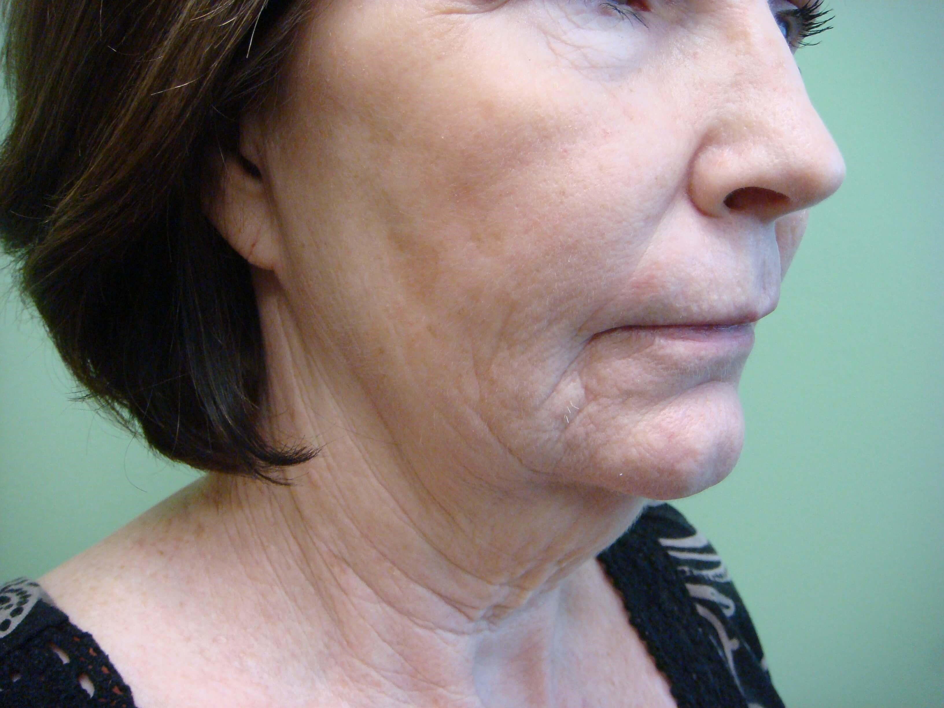 Necklift Before