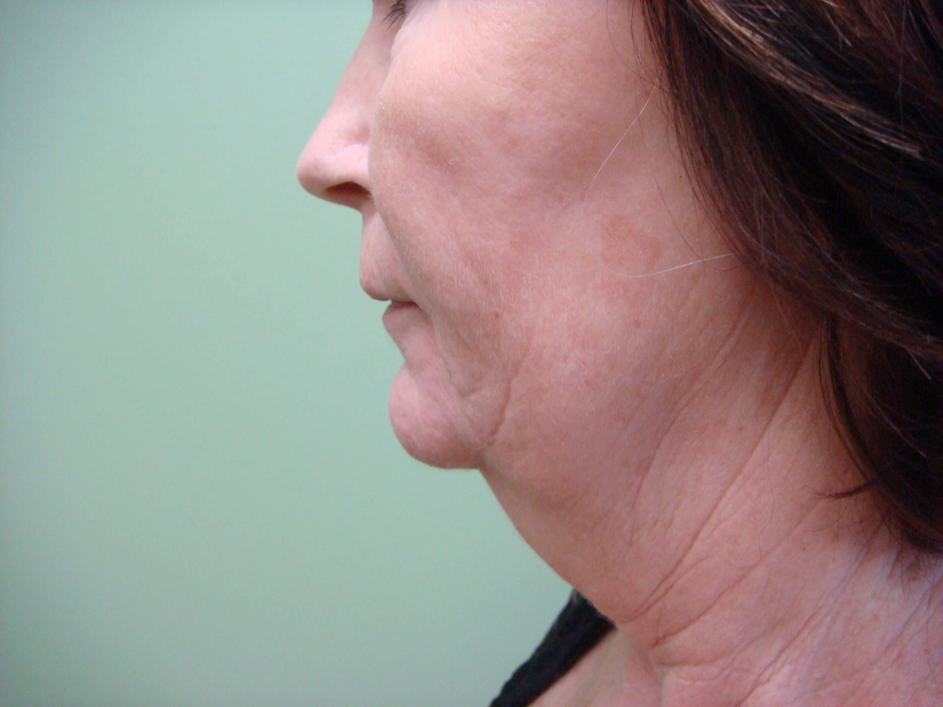 Necklift Before