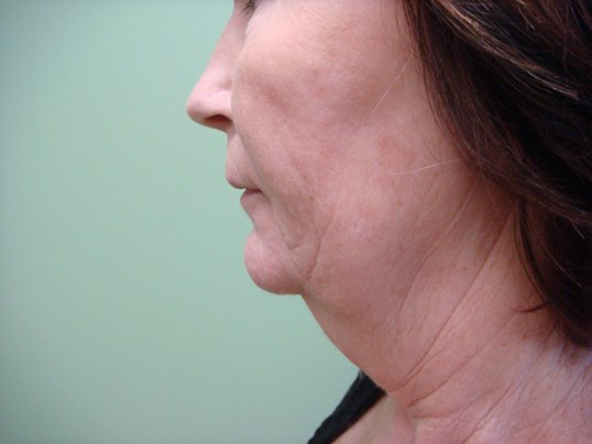 Necklift Before