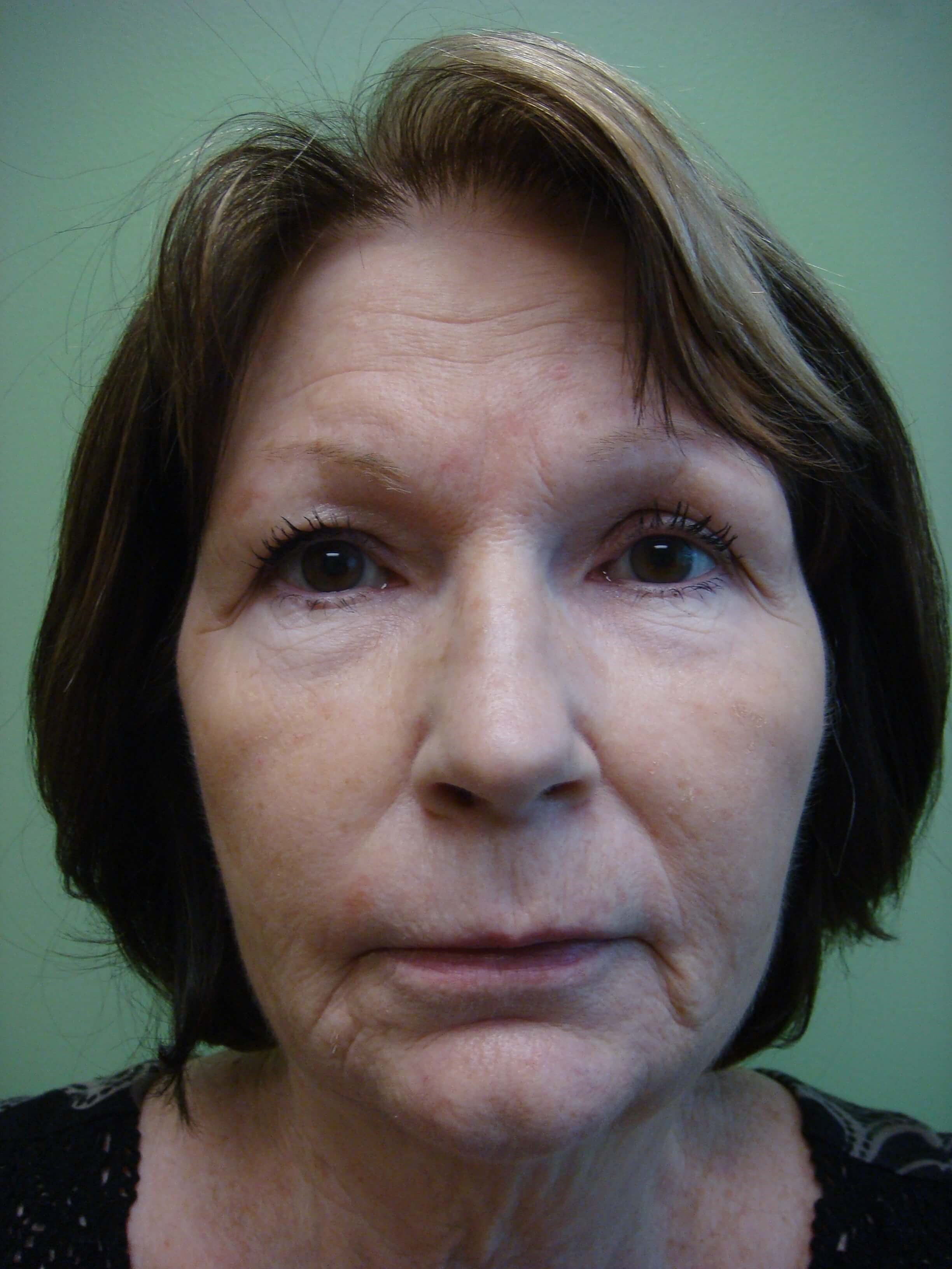 Necklift Before
