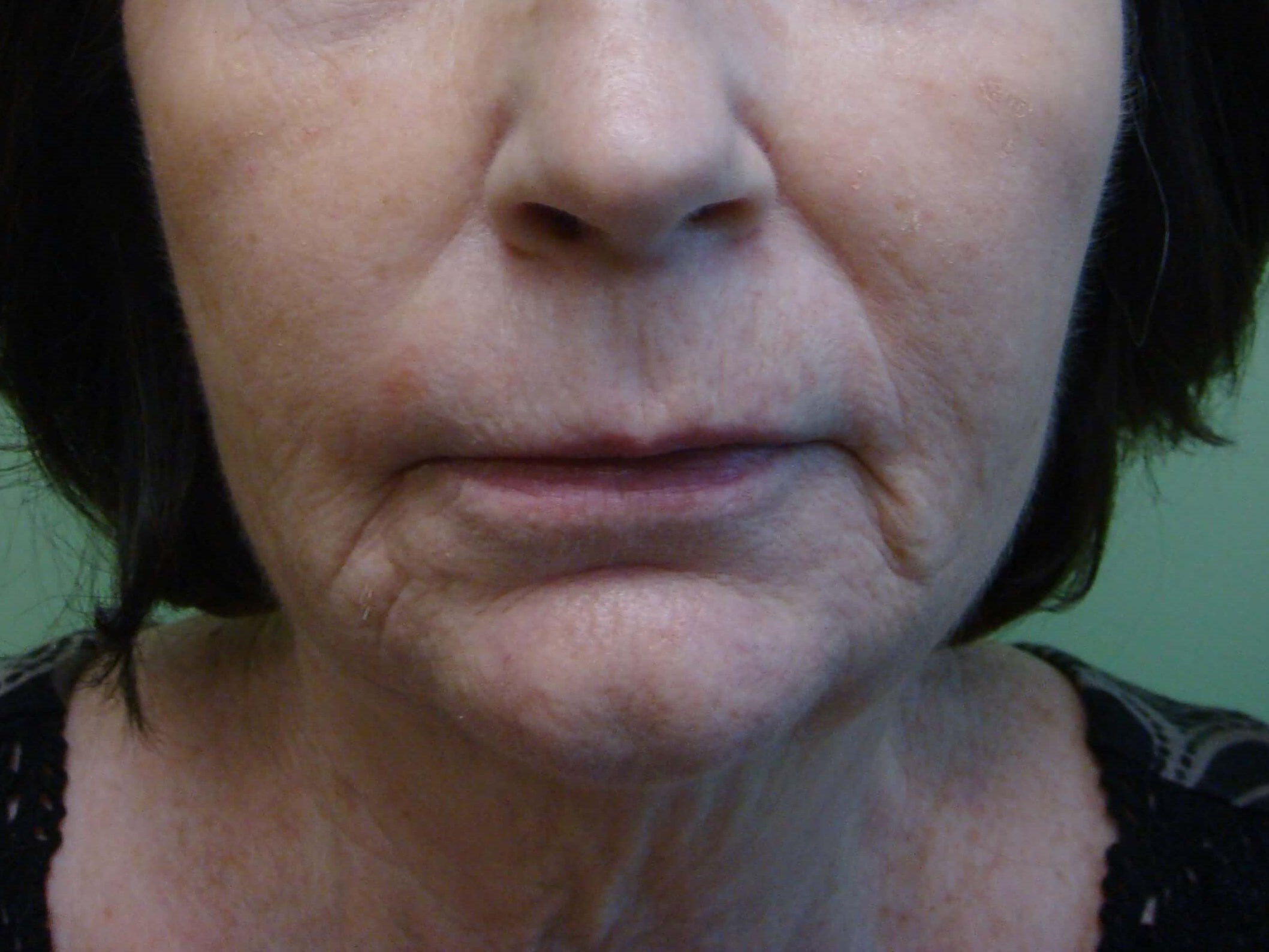 Necklift Before