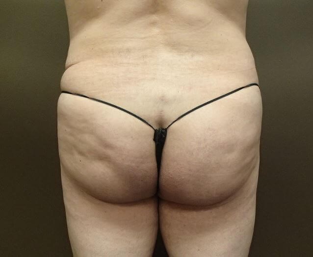 Auto Fat to Buttocks After
