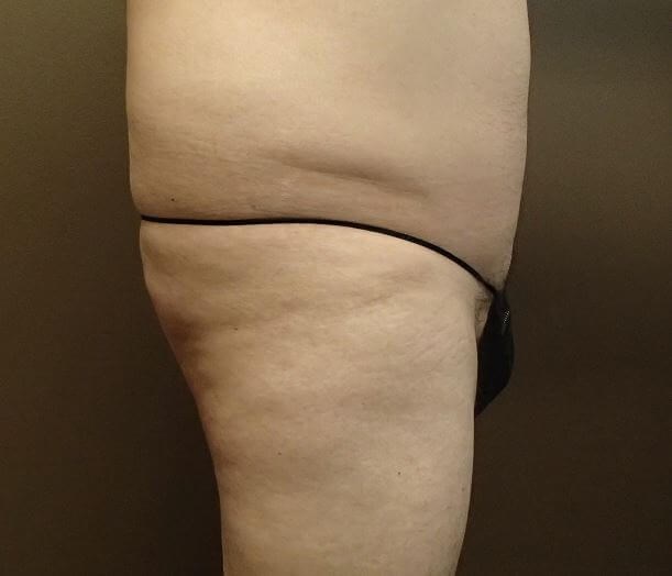 Auto Fat to Buttocks Before
