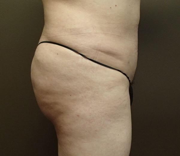 Auto Fat to Buttocks After