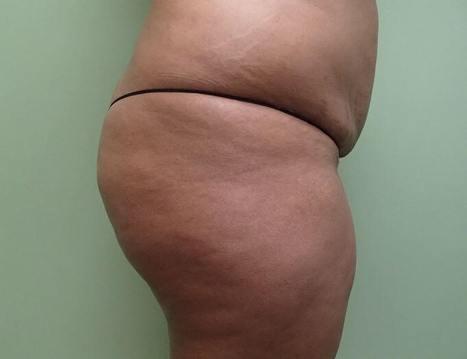 Auto Fat to Buttocks Before