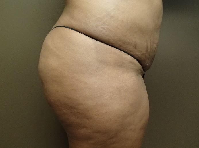 Auto Fat to Buttocks After