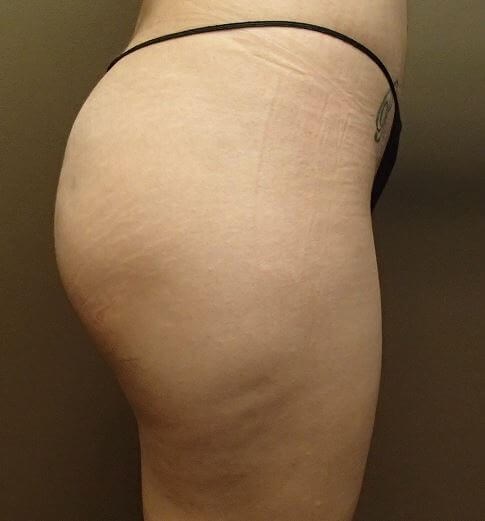Auto Fat to Buttocks After