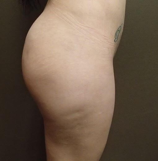 Auto Fat to Buttocks Before