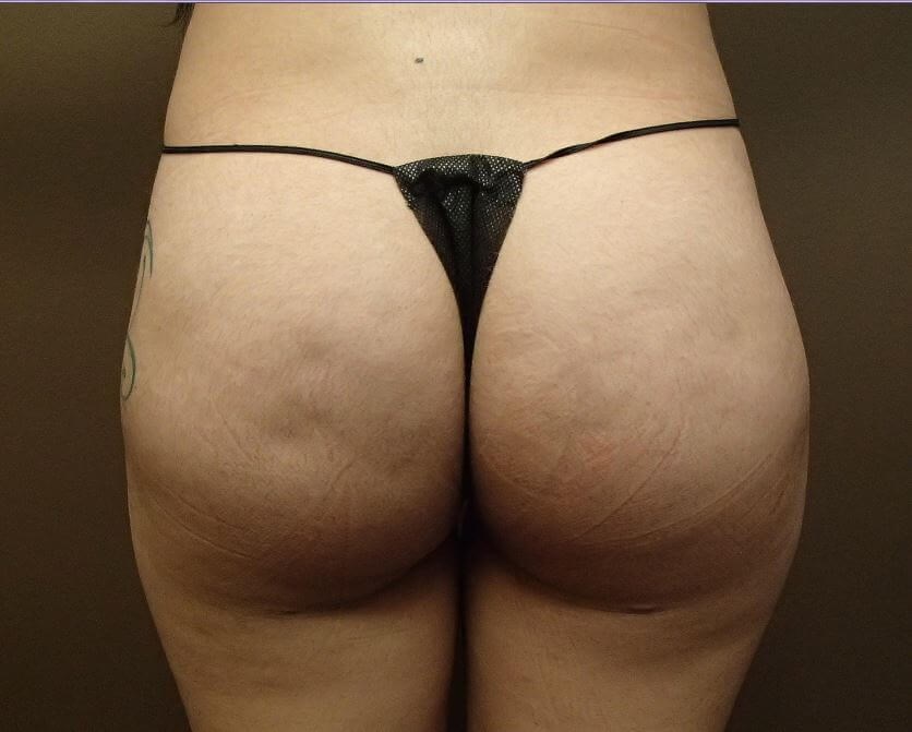 Auto Fat to Buttocks After