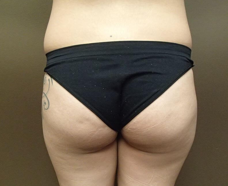 Auto Fat to Buttocks Before