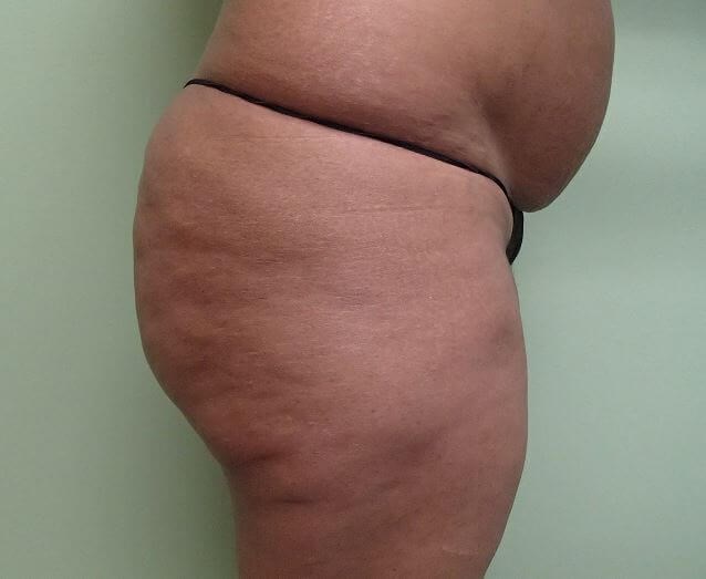 Auto Fat to Buttocks Before
