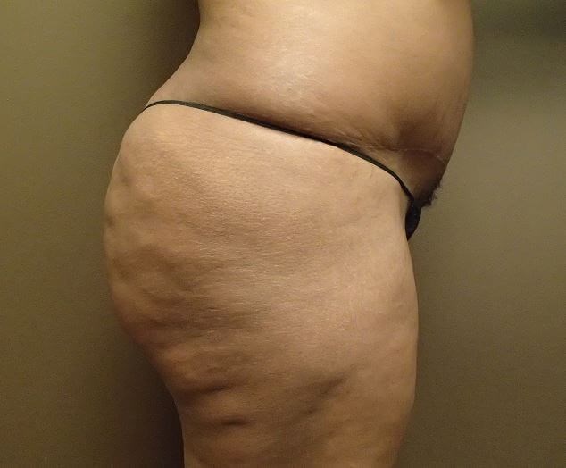 Auto Fat to Buttocks After